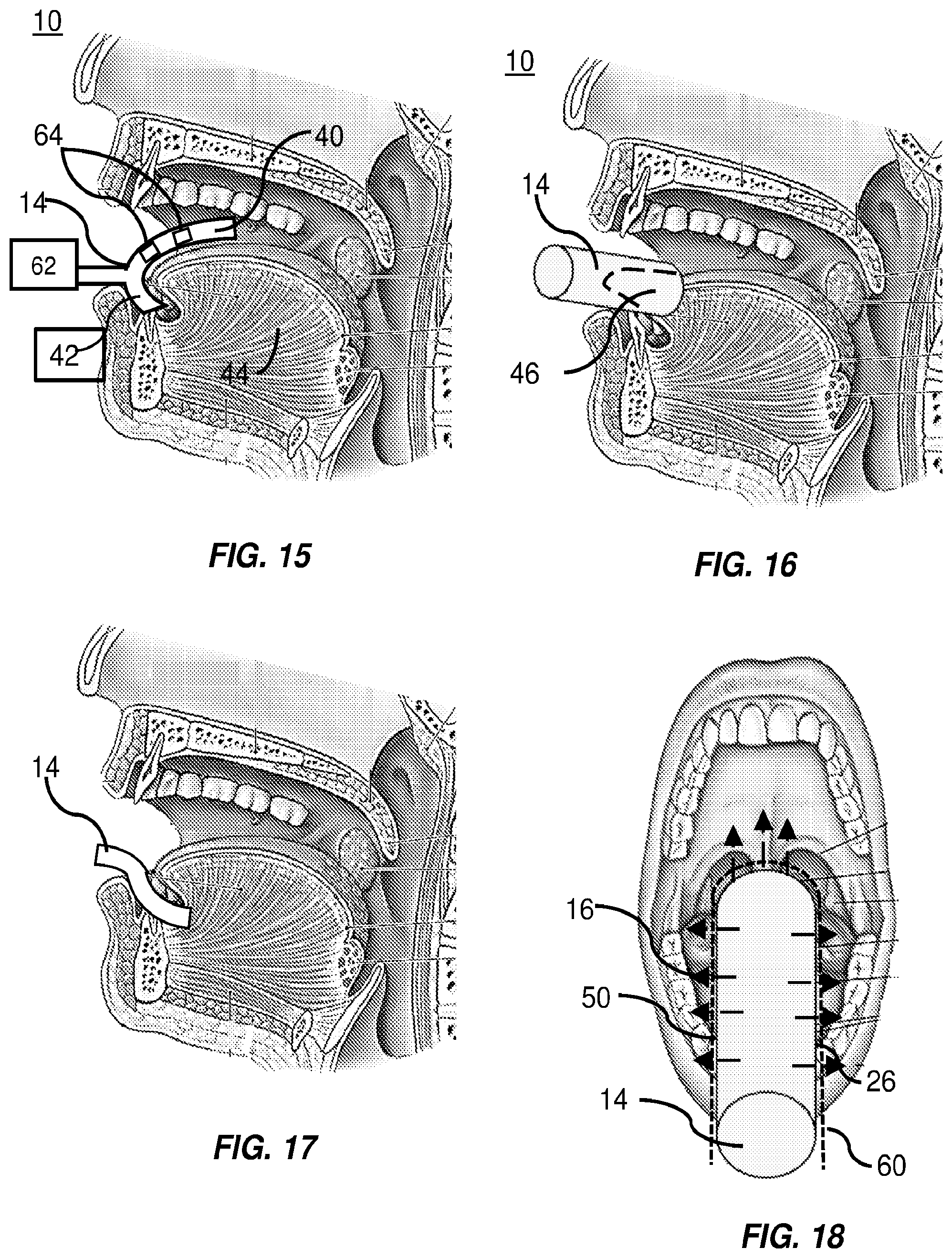 Patent US12551715 Figure 6 – Intraoral phototherapy probe