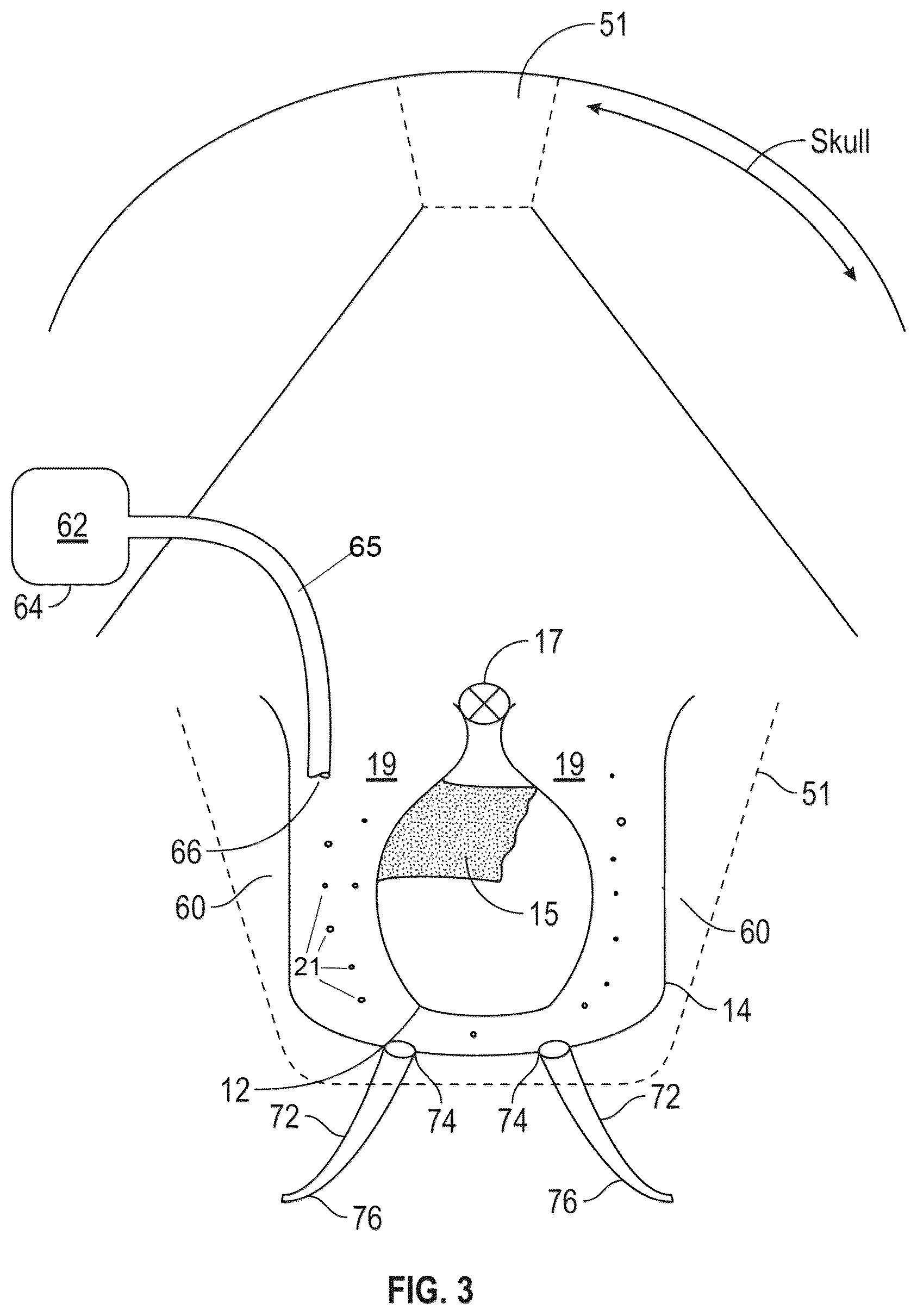 Patent US12551719 Figure 3 – Pulsating brachytherapy method and system