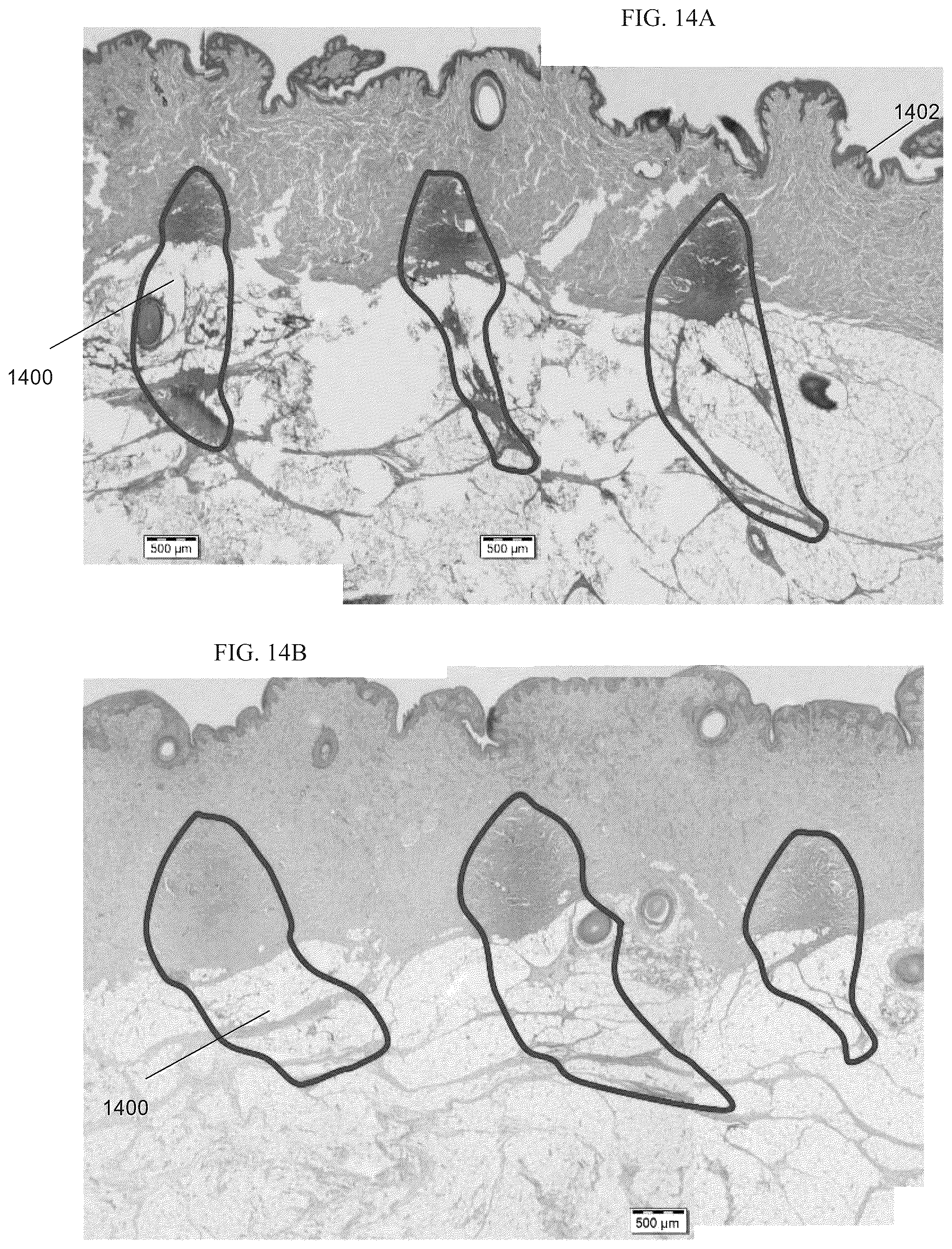 Patent US12551731 Figure 15 – Ultrasound transducer and system