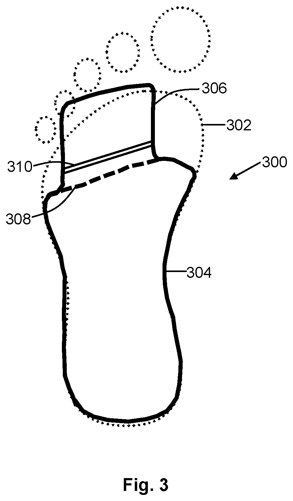 Patent US12552120 Figure 3 – Personalizing foot supports