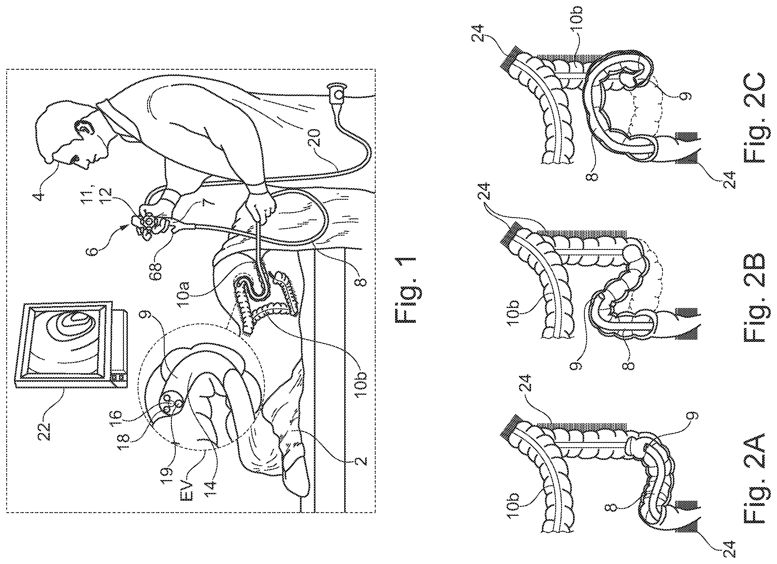 Patent US12564314 Figure 1 – Endoscope with variable stiffness