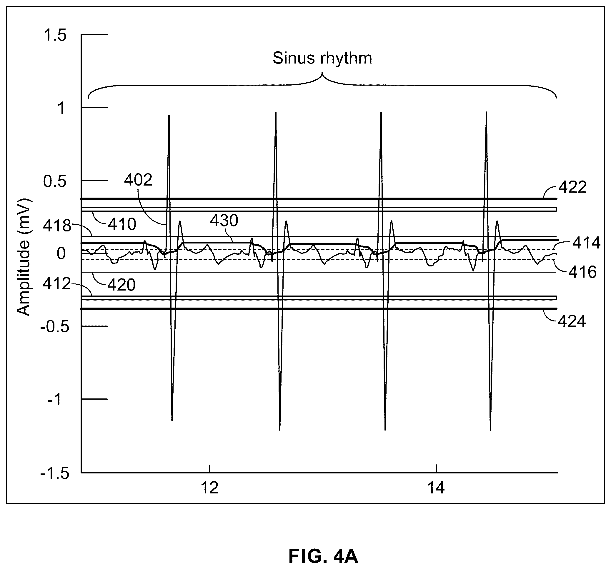 Patent US12564348 Figure 4 – Device and method for detecting ventricular arrhythmias based on duty cycle characteristics