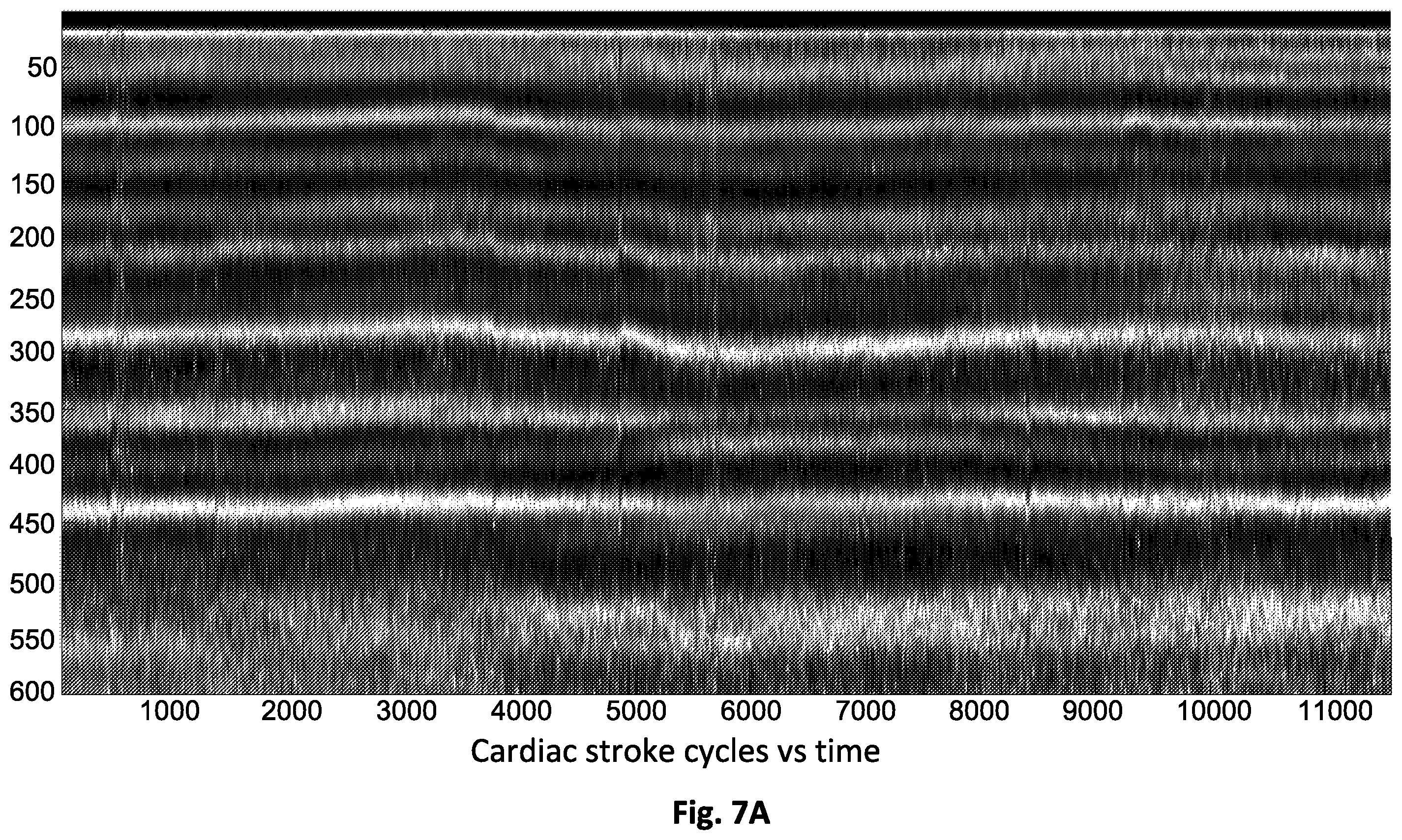 Patent US12564355 Figure 7 – Micro motion detection for determining at least one vital sign of a subject