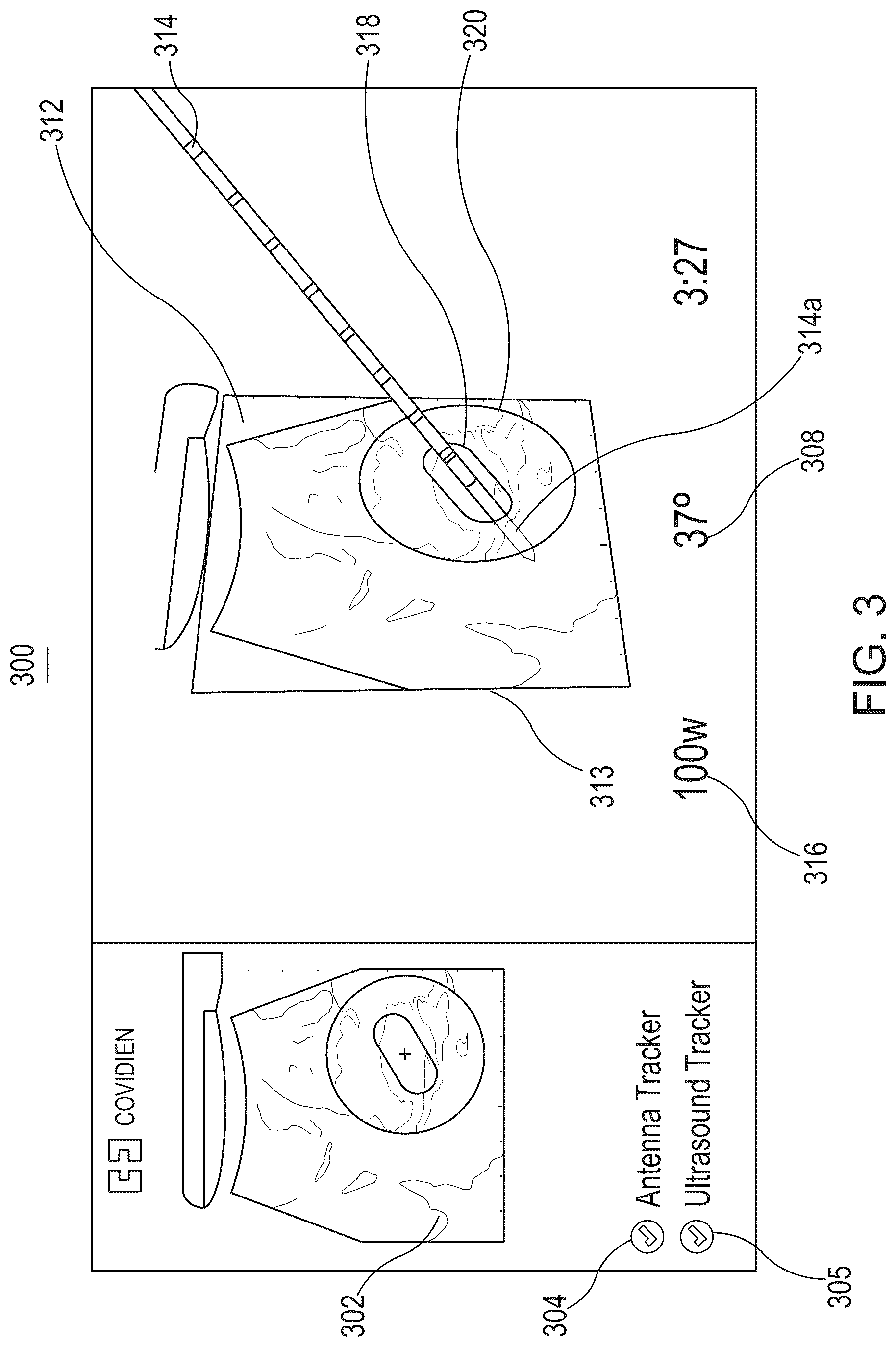 Patent US12564371 Figure 3 – System and method for displaying ablation zone progression