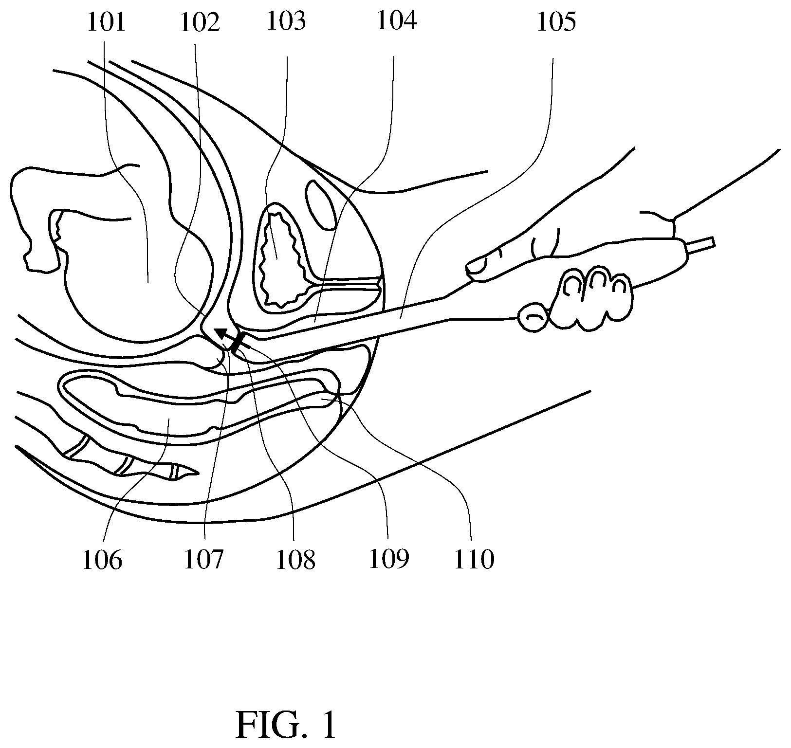 Patent US12564372 Figure 1 – Tactile ultrasound method and probe for predicting preterm birth