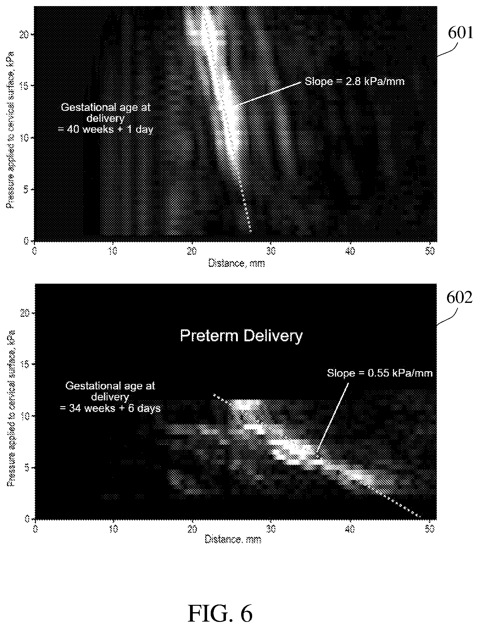 Patent US12564372 Figure 6 – Tactile ultrasound method and probe for predicting preterm birth