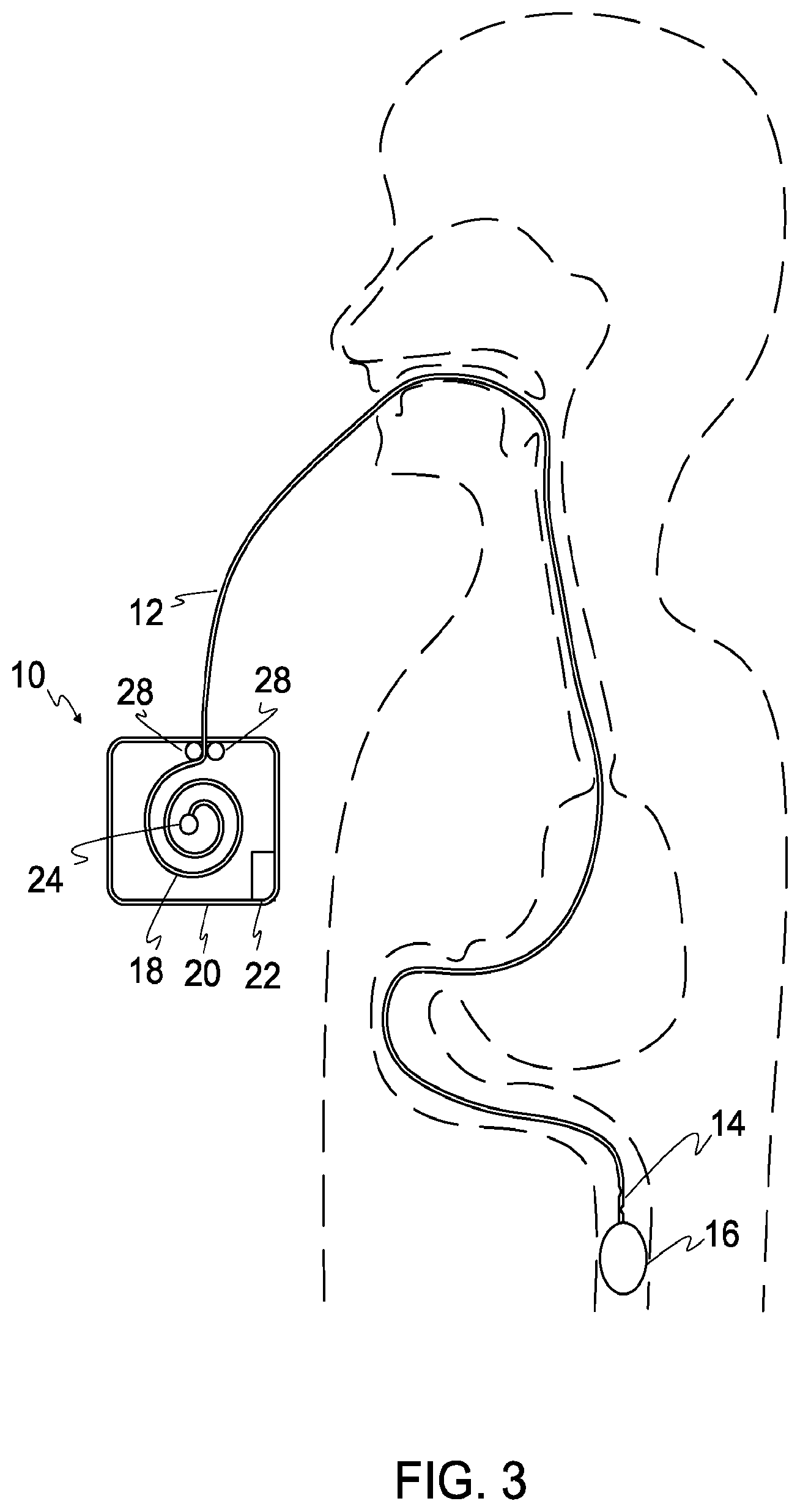 Patent US12564389 Figure 3 – Devices and methods for sampling gastrointestinal fluids and assessing gastrointestinal function