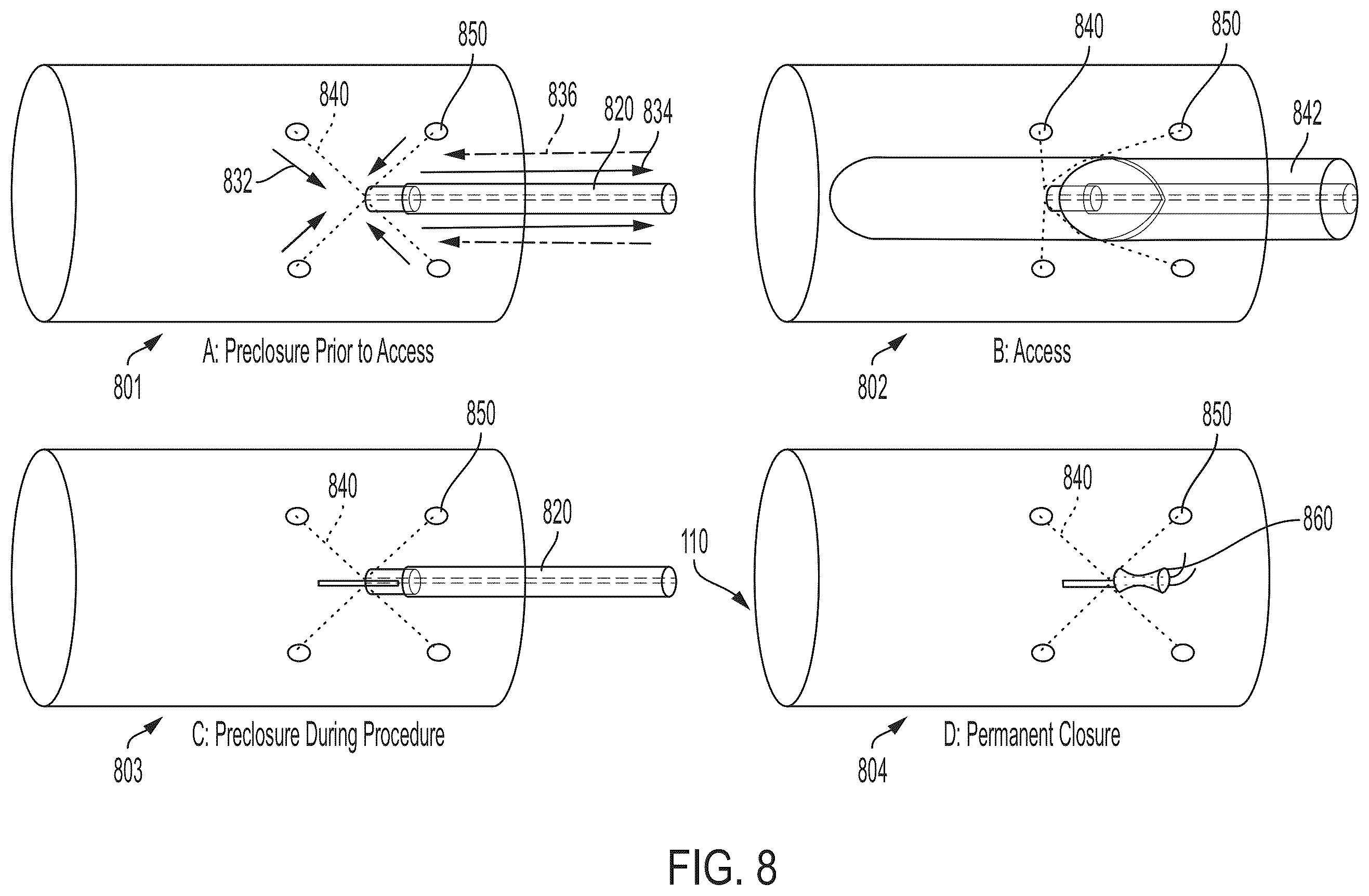 Patent US12564393 Figure 11 – Access site management system for percutaneous vascular access