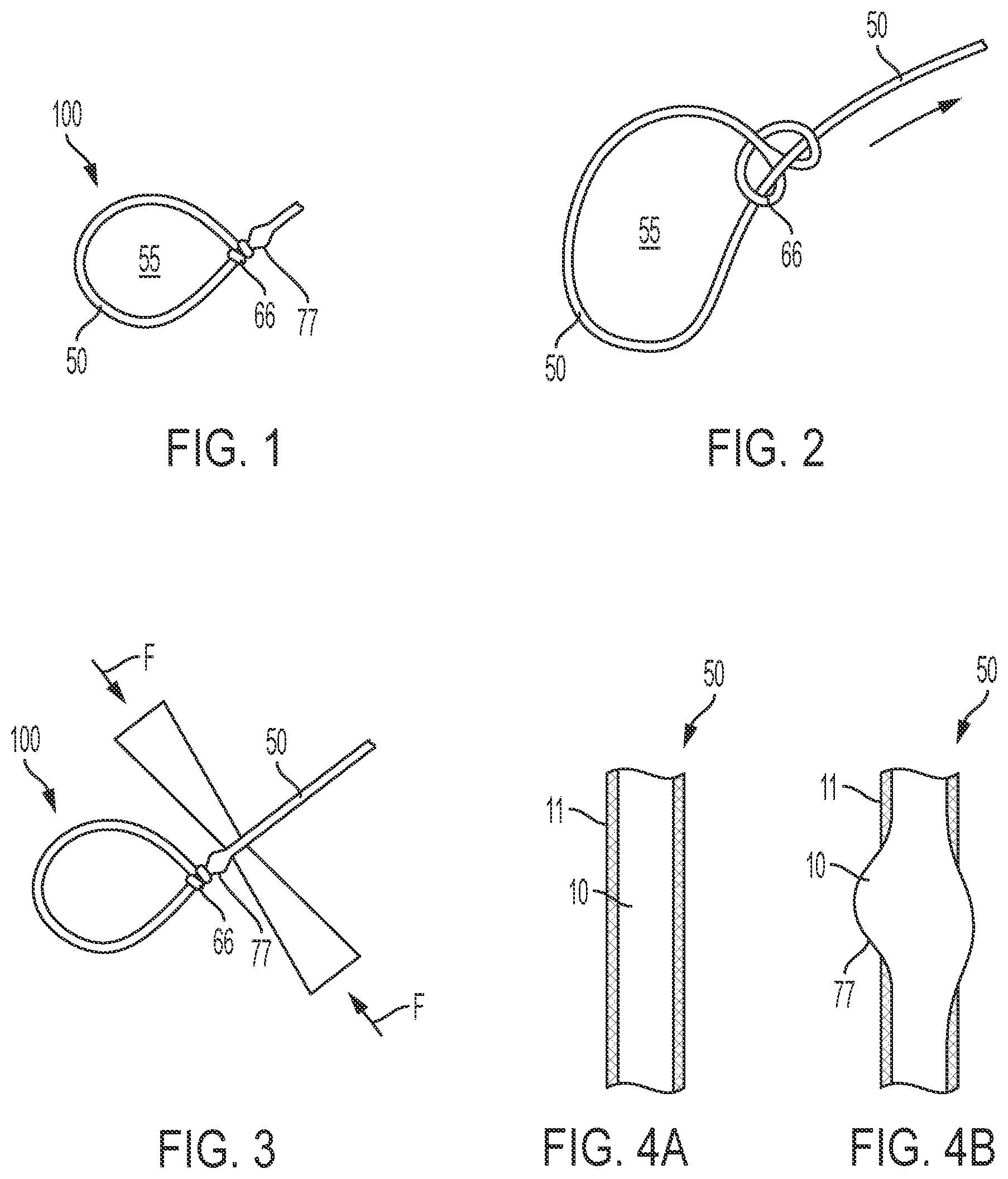 Patent US12564399 — Tensionable knotless surgical techniques — Figure 1