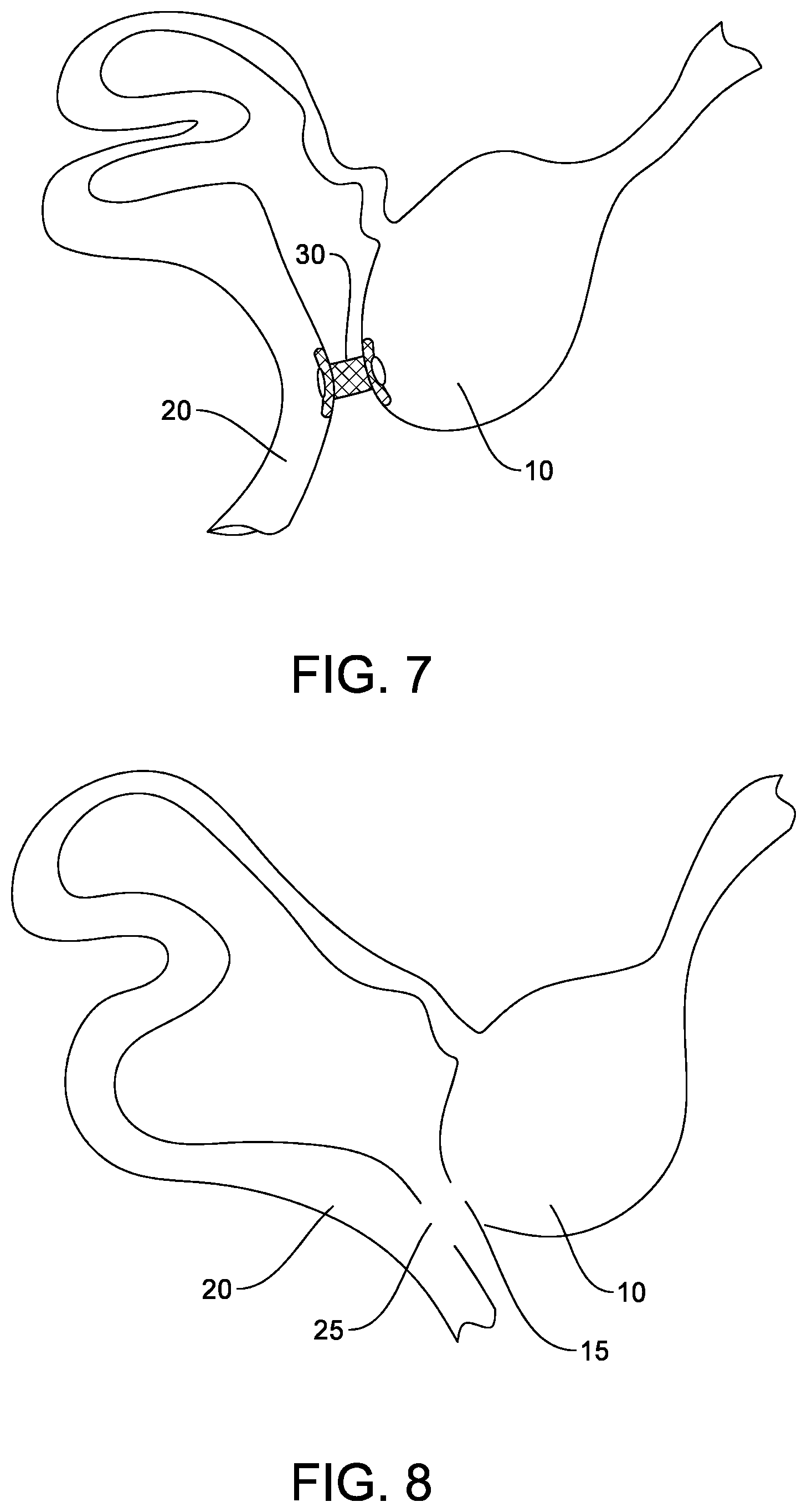 Patent US12564402 Figure 4 – Reverse anastomosis closure clip