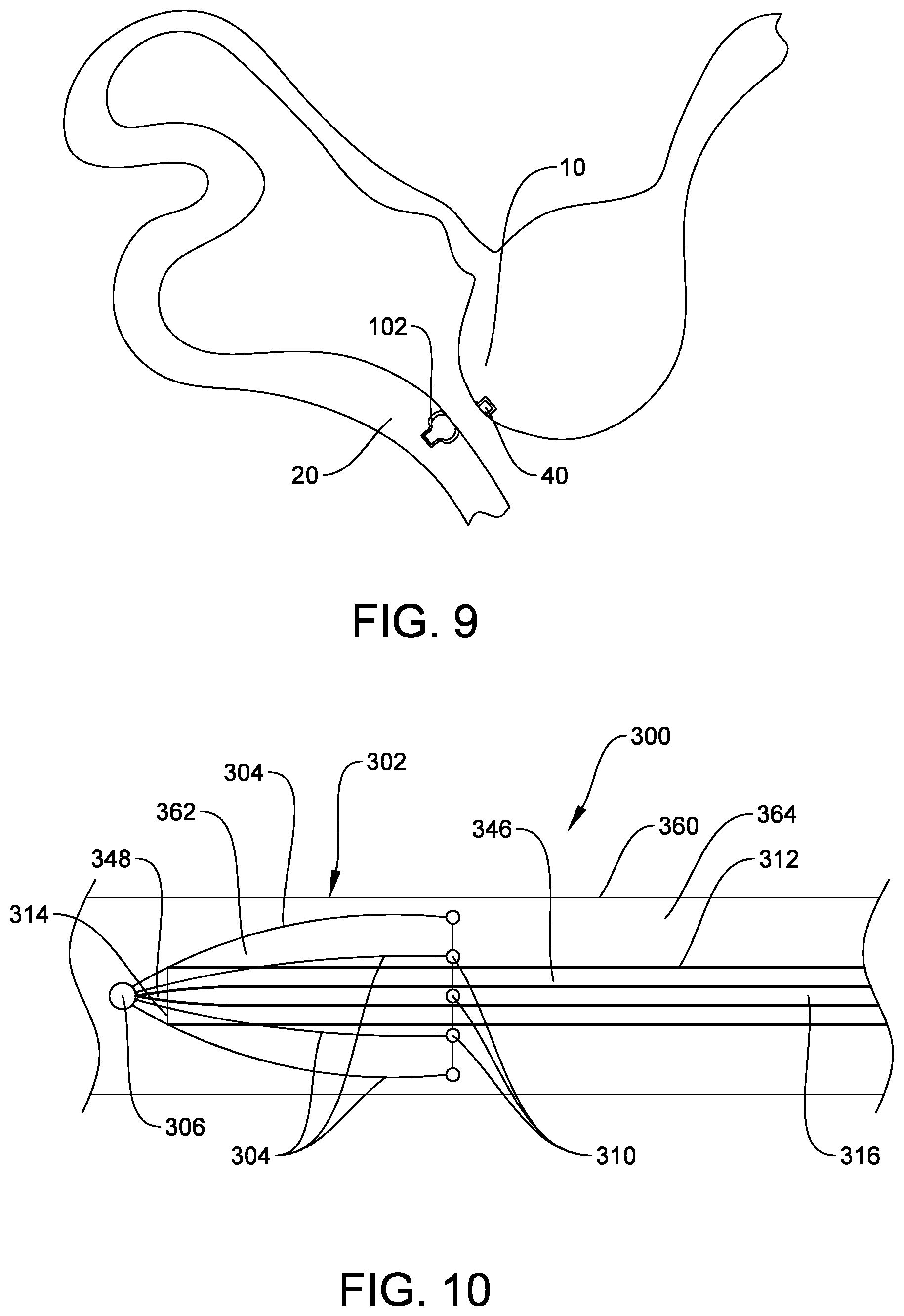 Patent US12564402 Figure 5 – Reverse anastomosis closure clip