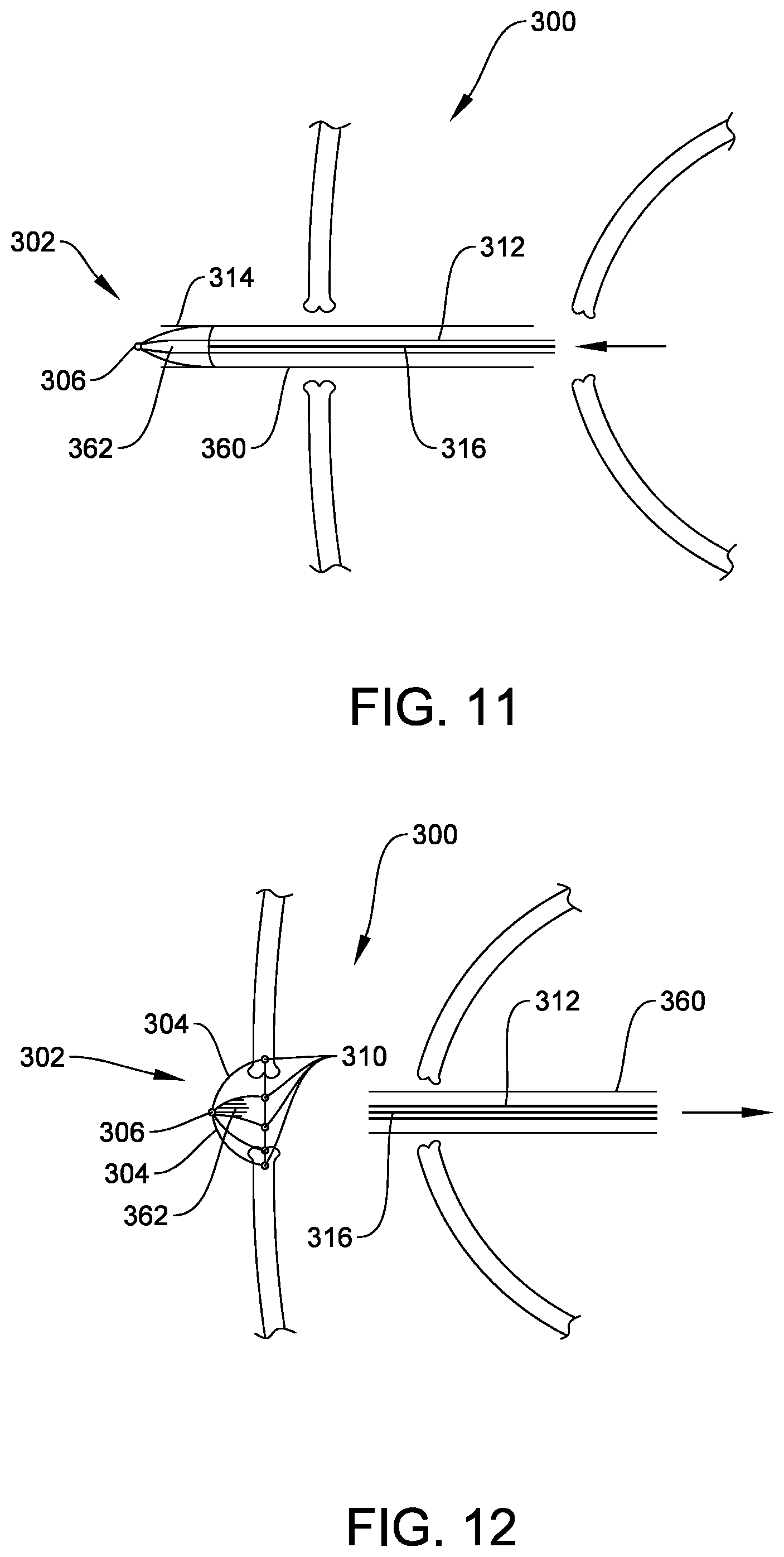 Patent US12564402 Figure 6 – Reverse anastomosis closure clip