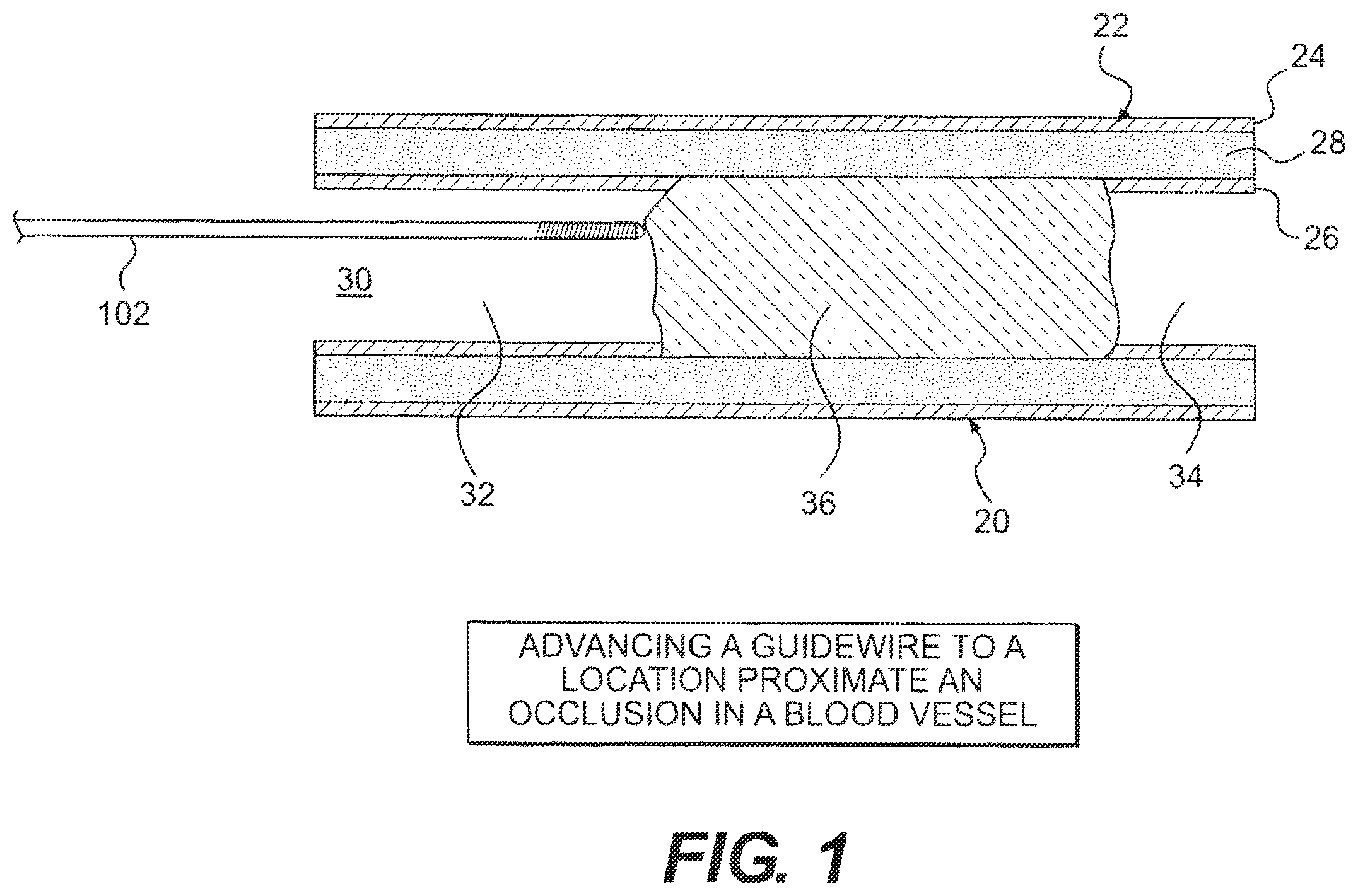 Patent US12564404 Figure 1 – Crossing occlusions in blood vessels