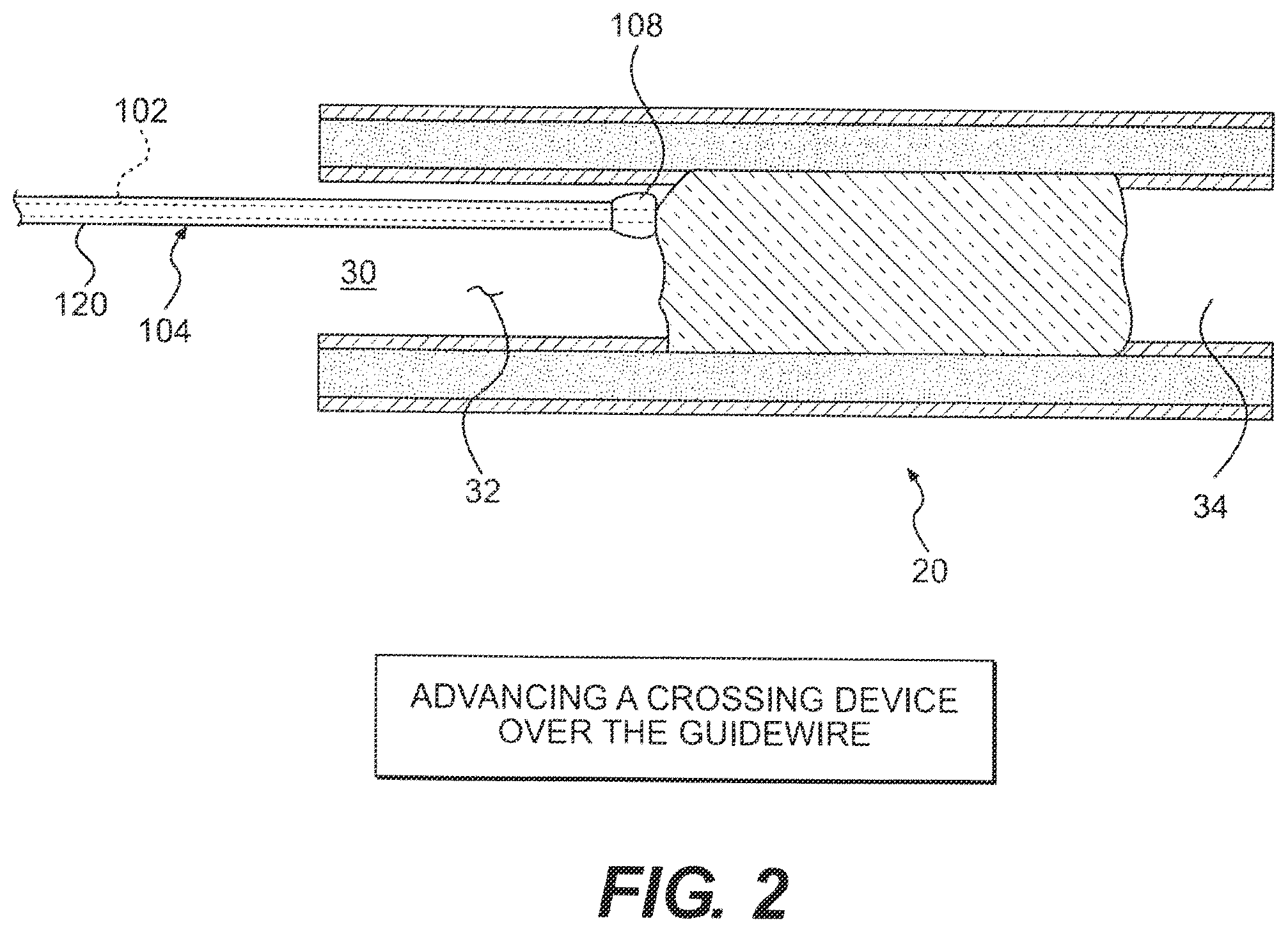 Patent US12564404 Figure 2 – Crossing occlusions in blood vessels