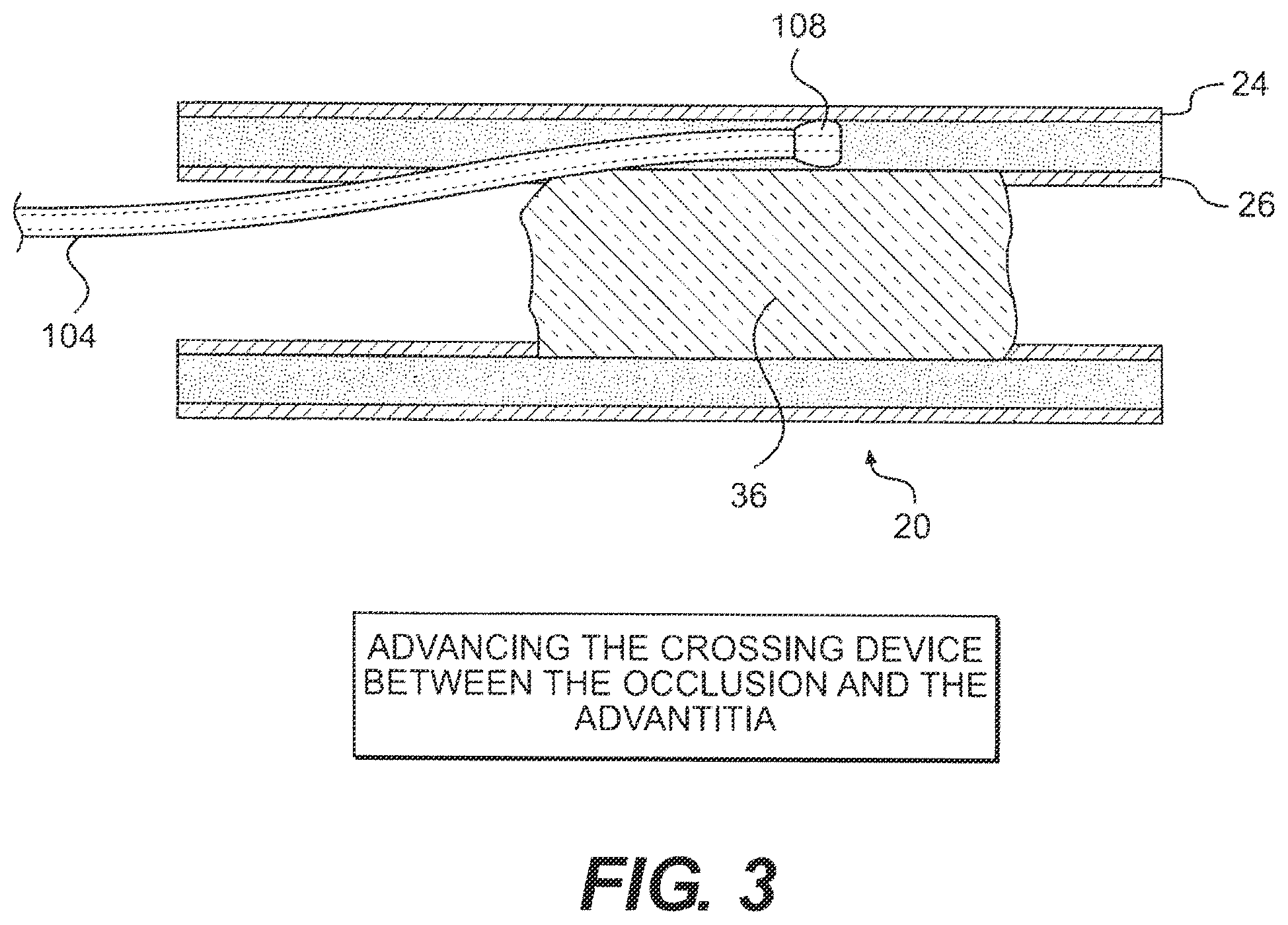 Patent US12564404 Figure 3 – Crossing occlusions in blood vessels