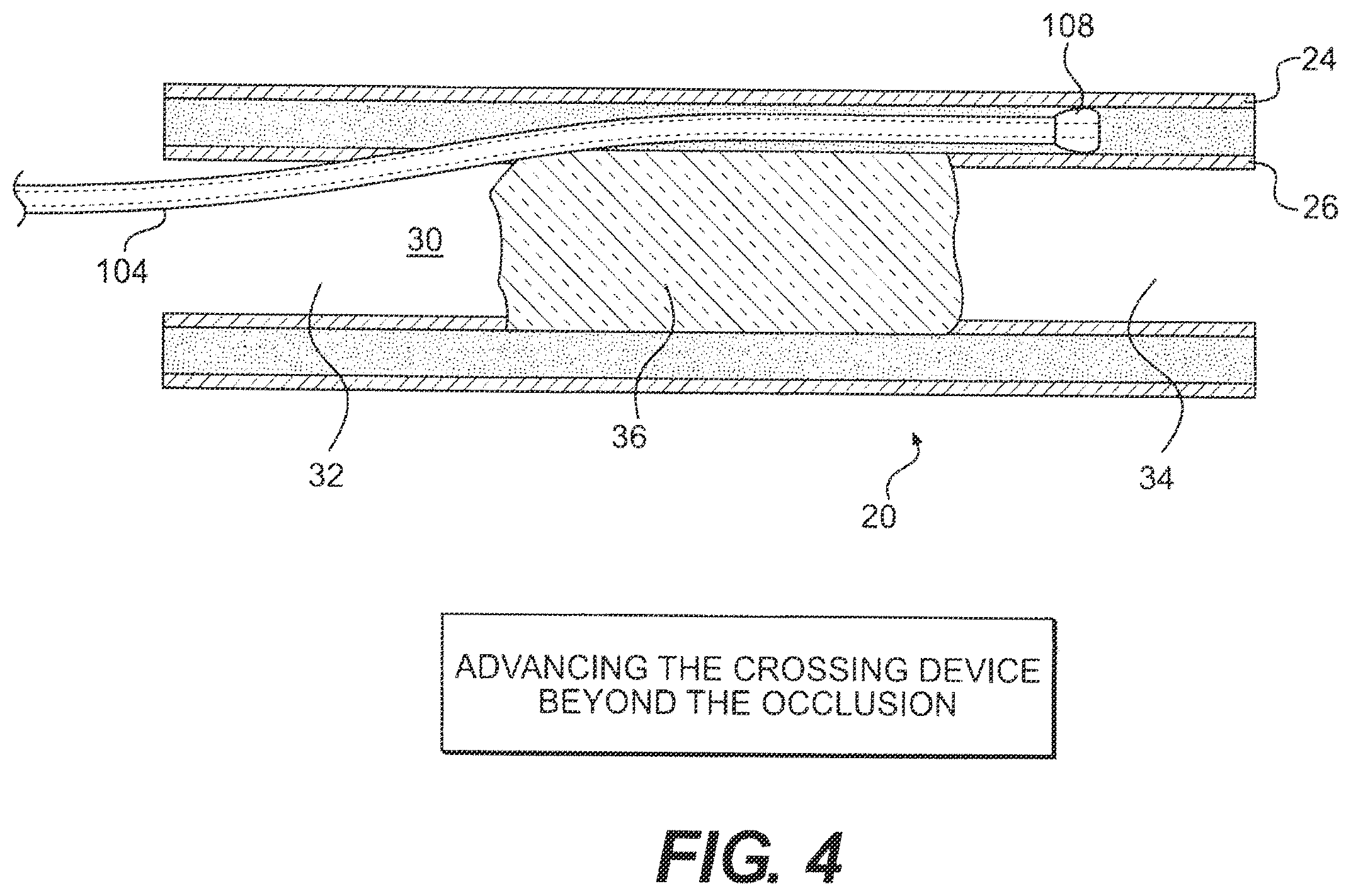 Patent US12564404 Figure 4 – Crossing occlusions in blood vessels