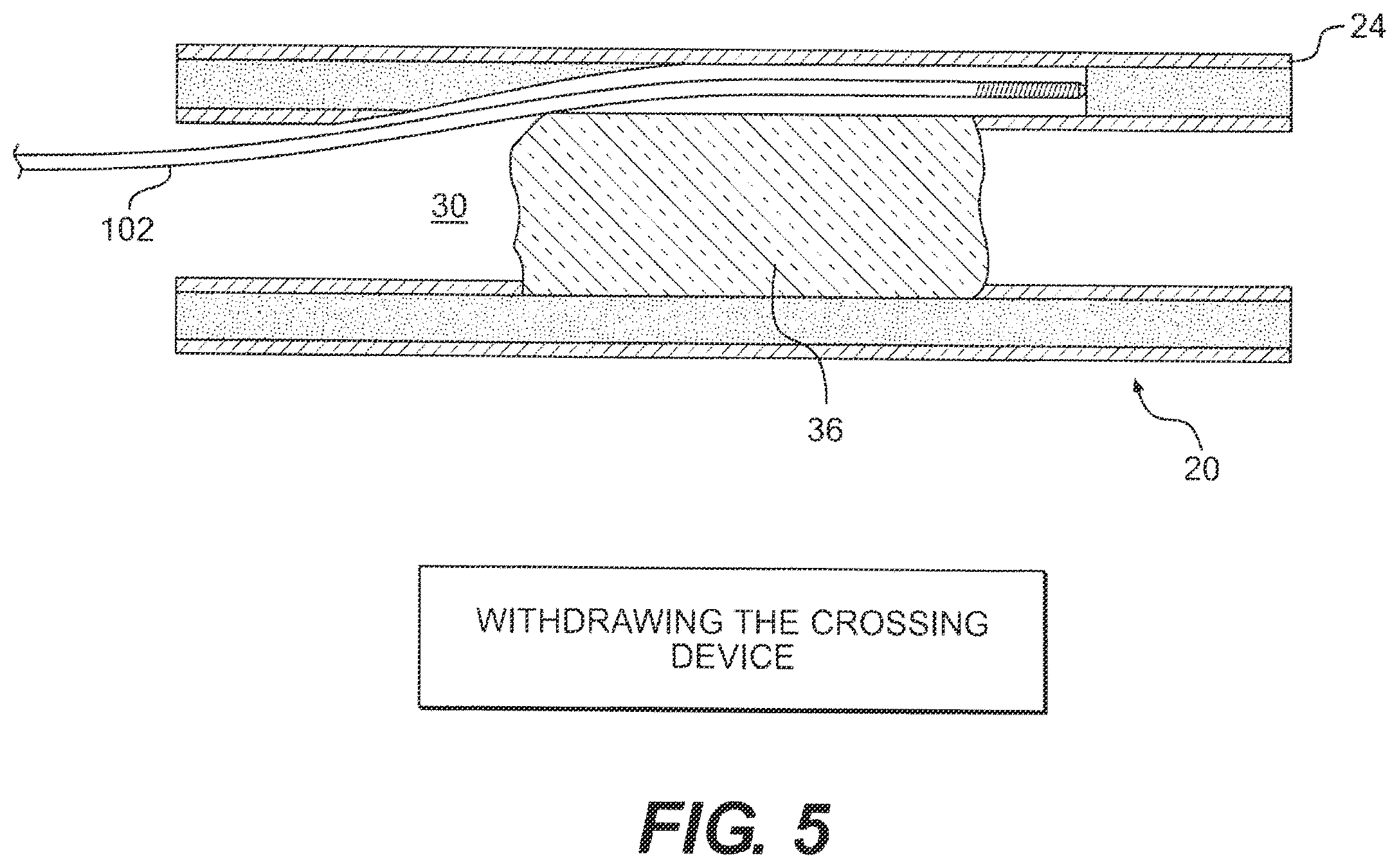 Patent US12564404 Figure 5 – Crossing occlusions in blood vessels