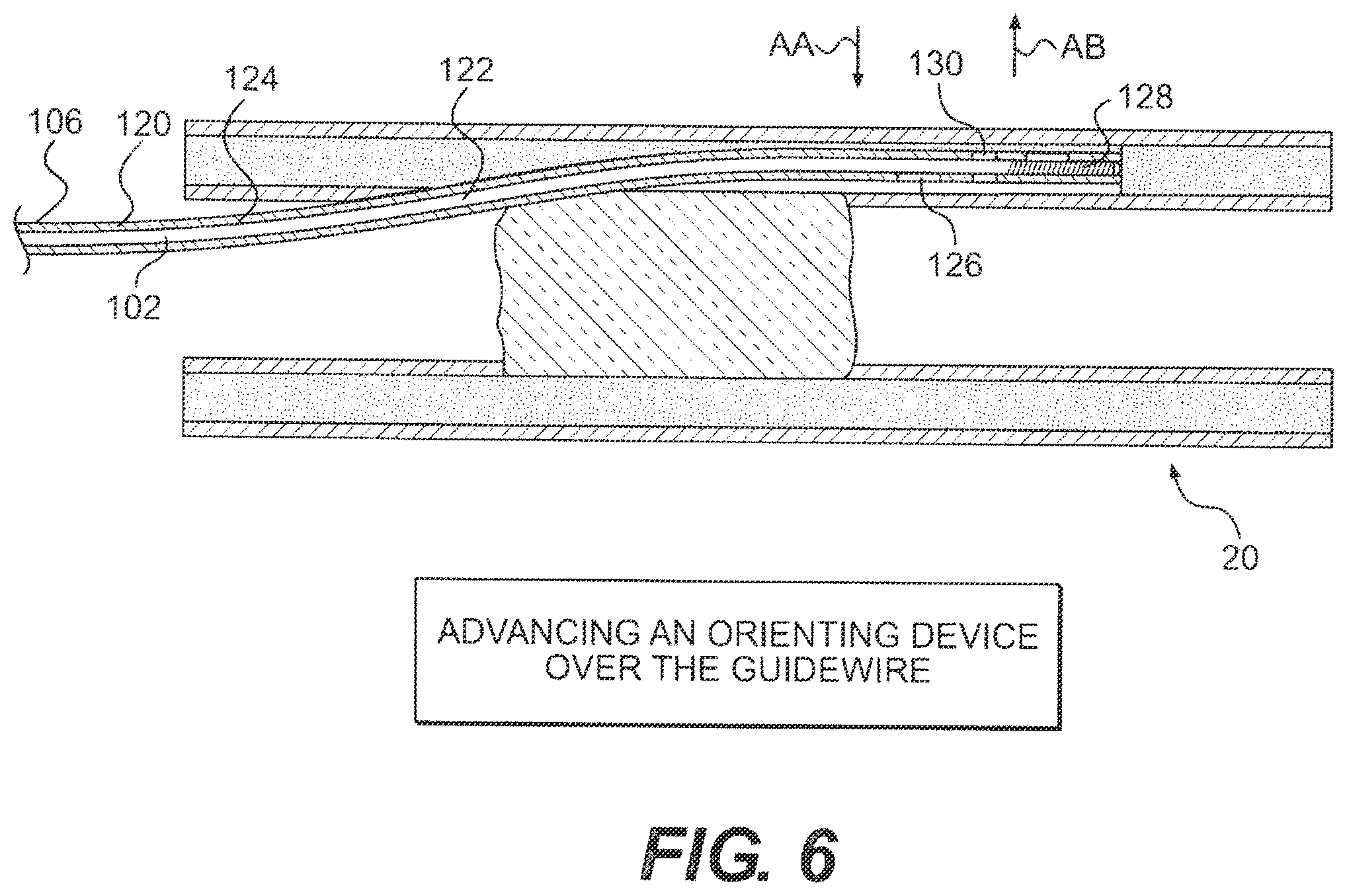Patent US12564404 Figure 6 – Crossing occlusions in blood vessels