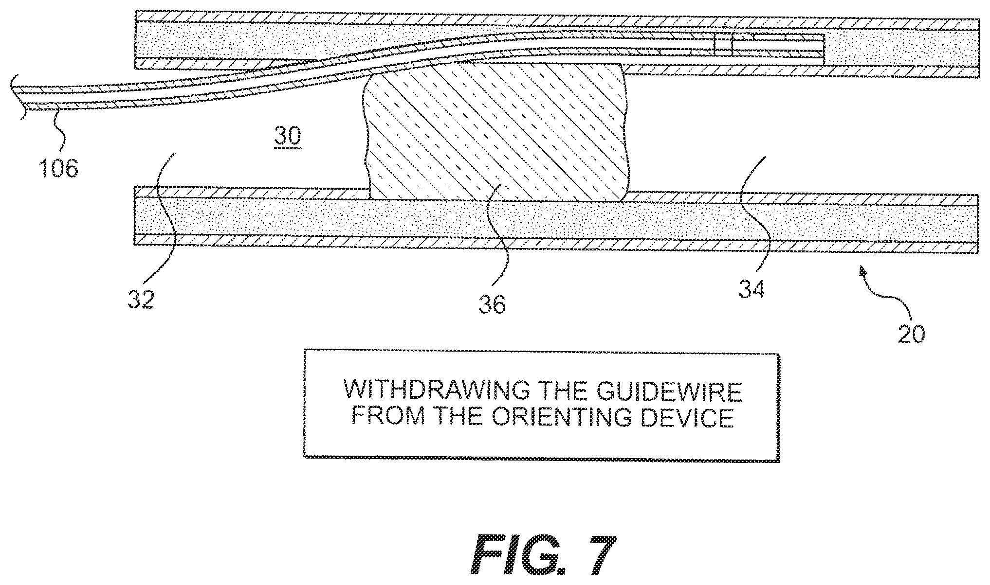 Patent US12564404 Figure 7 – Crossing occlusions in blood vessels