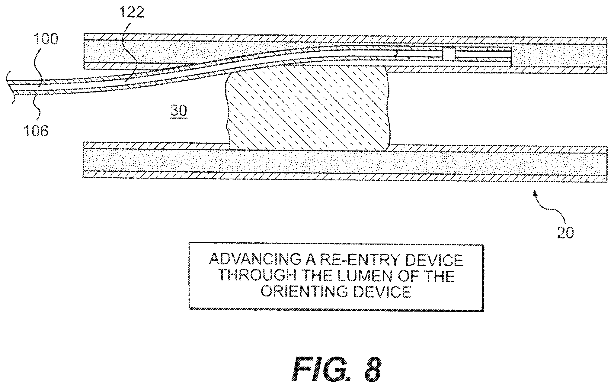 Patent US12564404 Figure 8 – Crossing occlusions in blood vessels