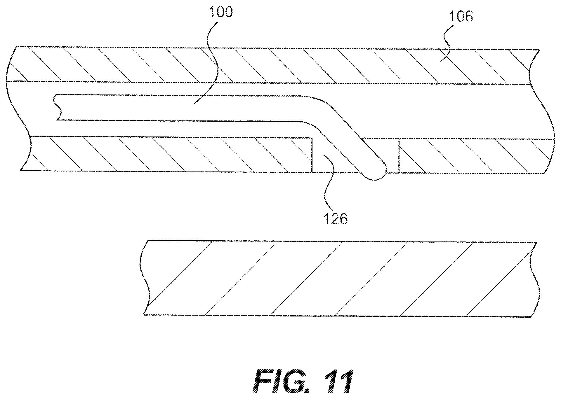 Patent US12564404 Figure 11 – Crossing occlusions in blood vessels