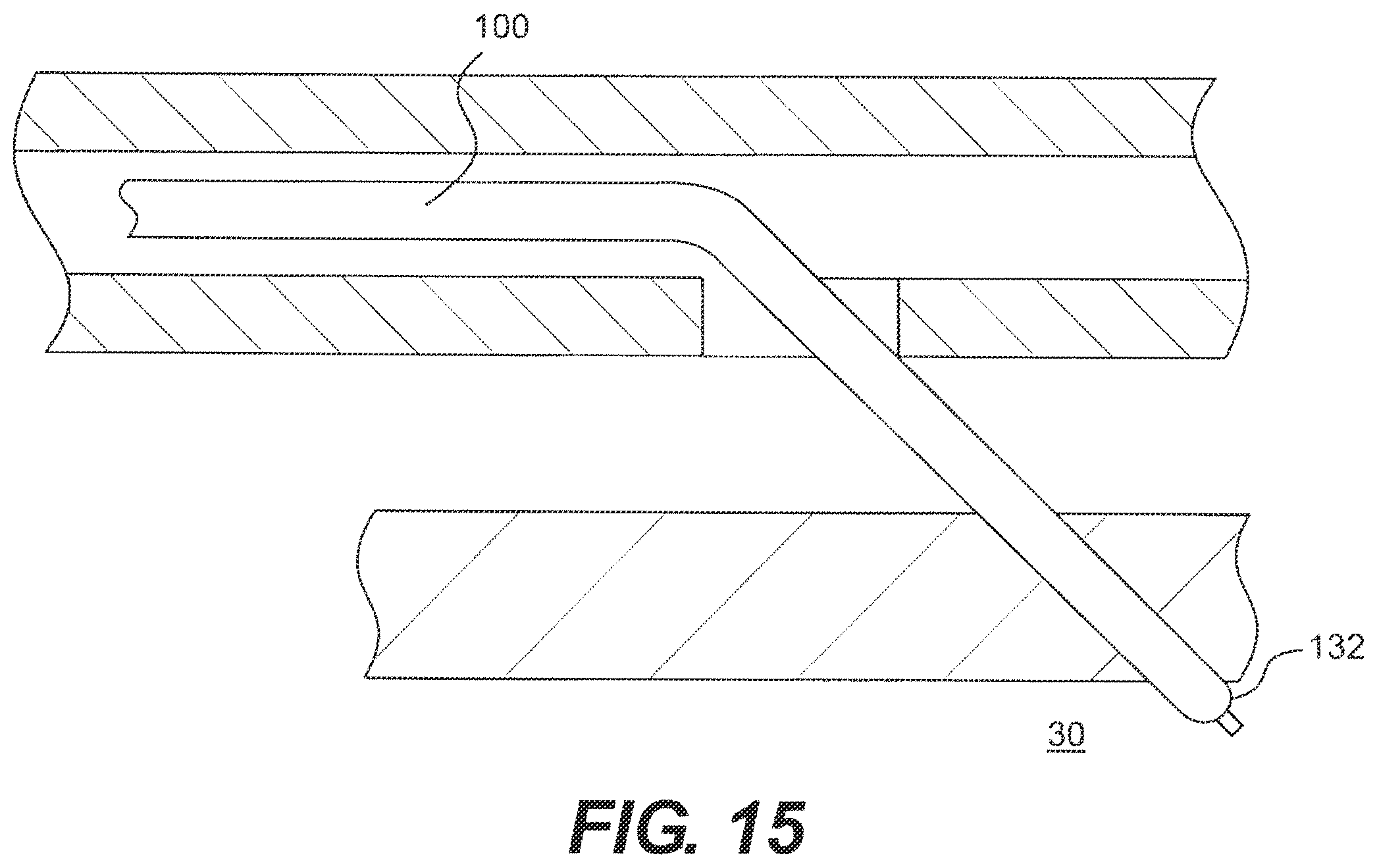 Patent US12564404 Figure 15 – Crossing occlusions in blood vessels