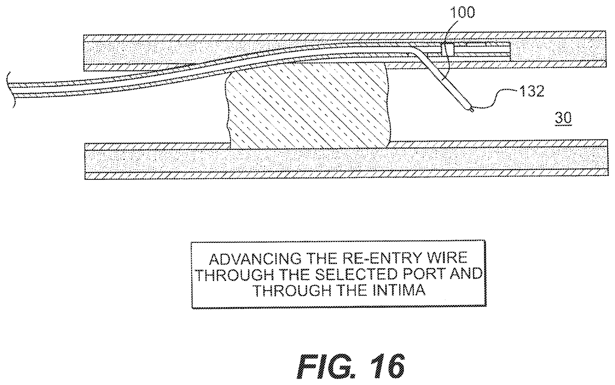Patent US12564404 Figure 16 – Crossing occlusions in blood vessels