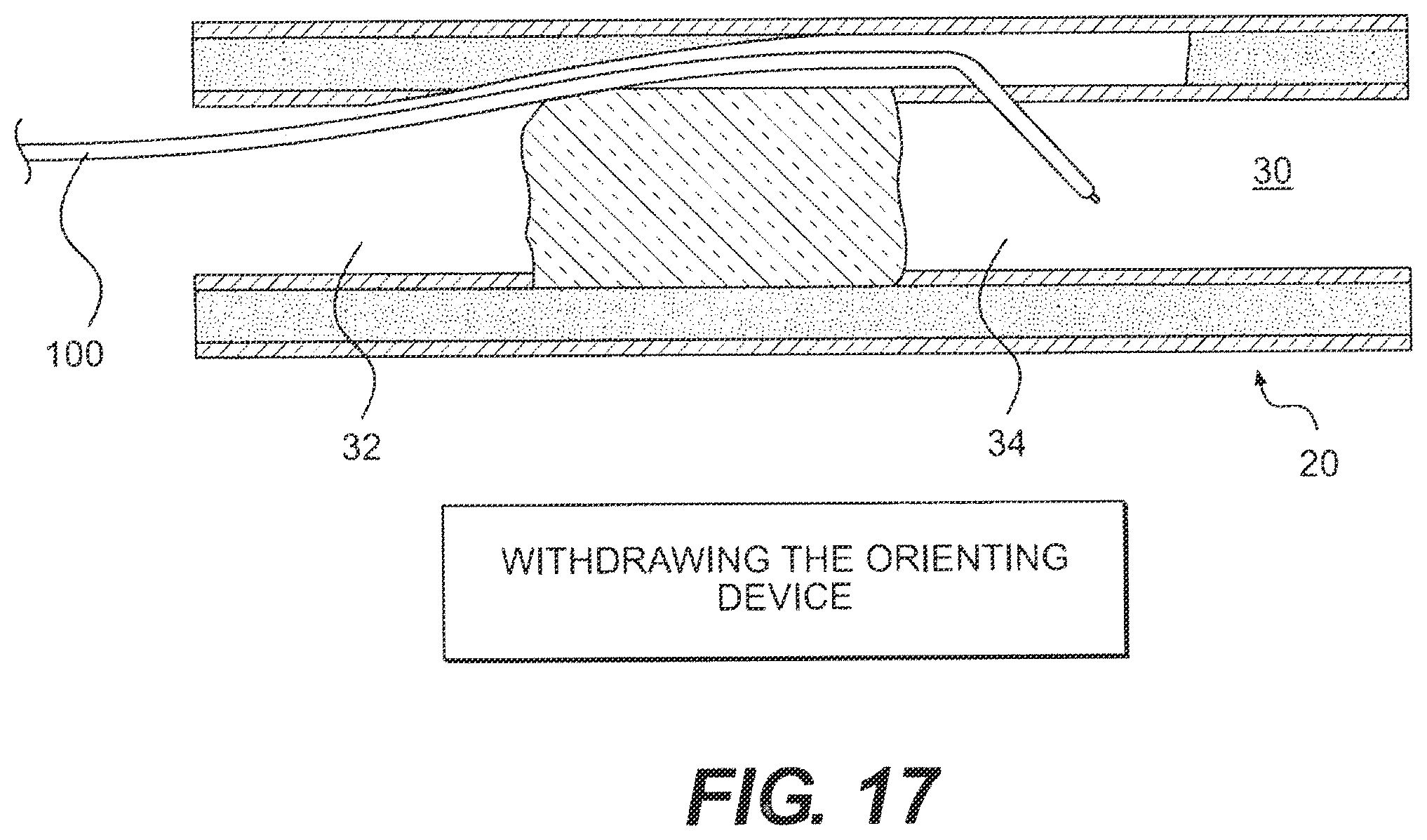 Patent US12564404 Figure 17 – Crossing occlusions in blood vessels