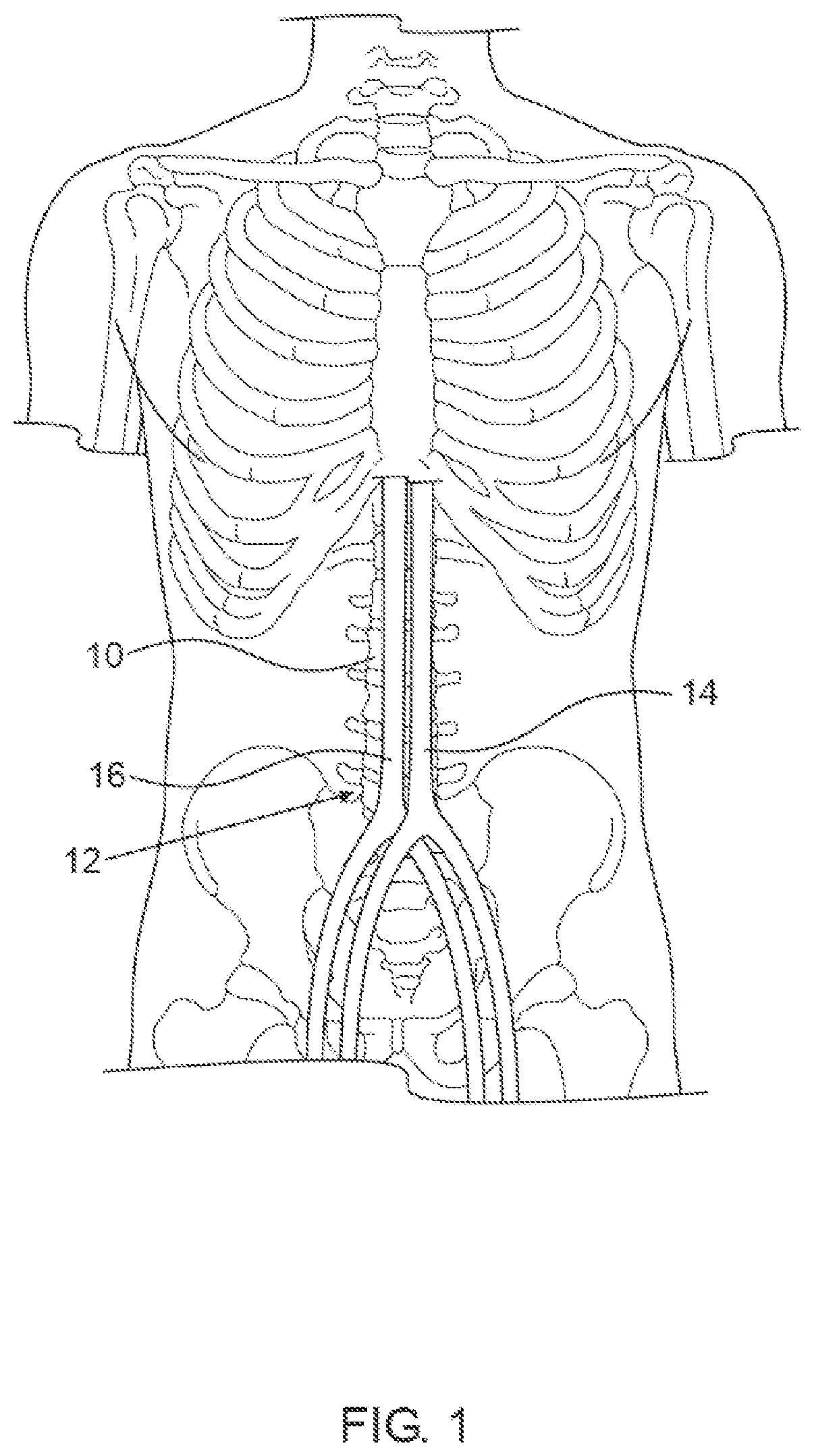 Patent US12564405 Figure 1 – Blood vessel compression systems