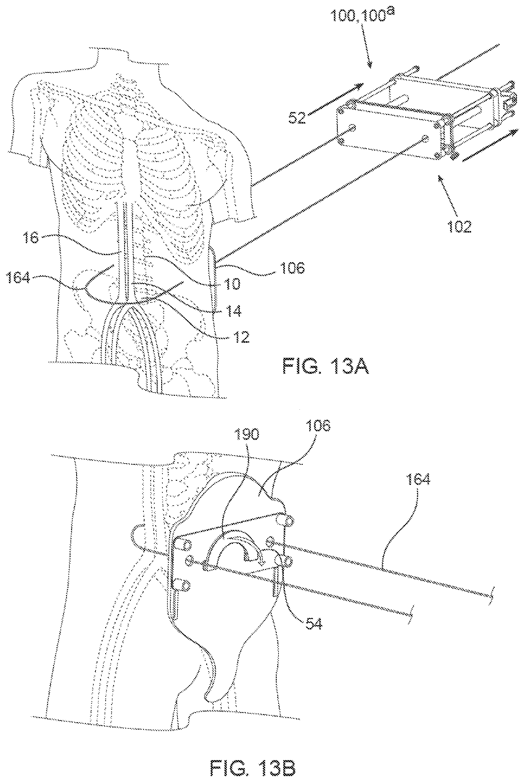 Patent US12564405 Figure 14 – Blood vessel compression systems