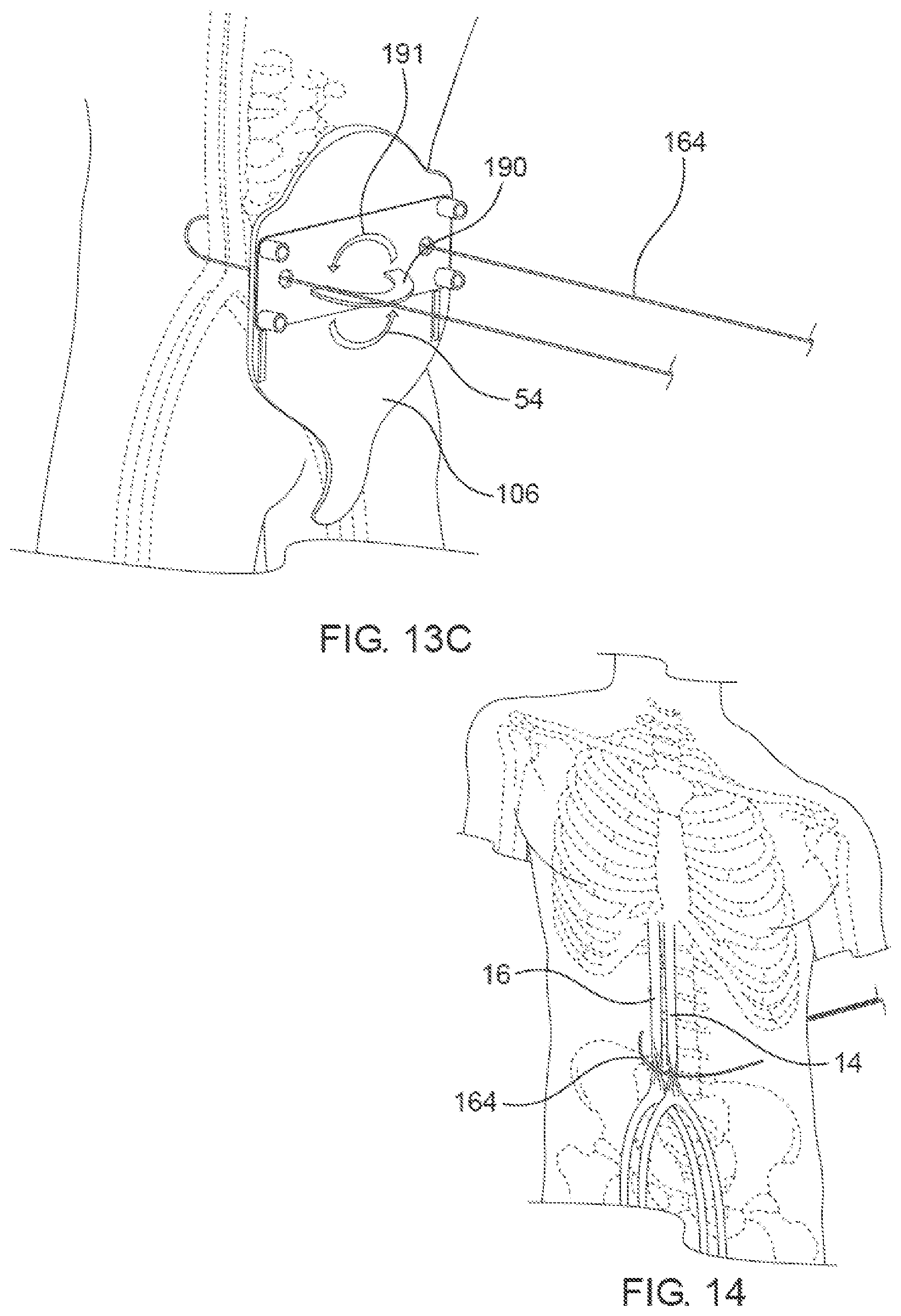 Patent US12564405 Figure 15 – Blood vessel compression systems