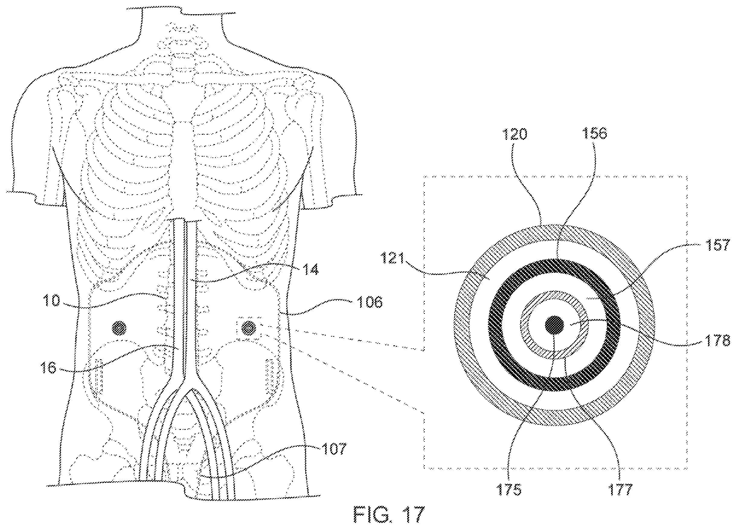 Patent US12564405 Figure 18 – Blood vessel compression systems