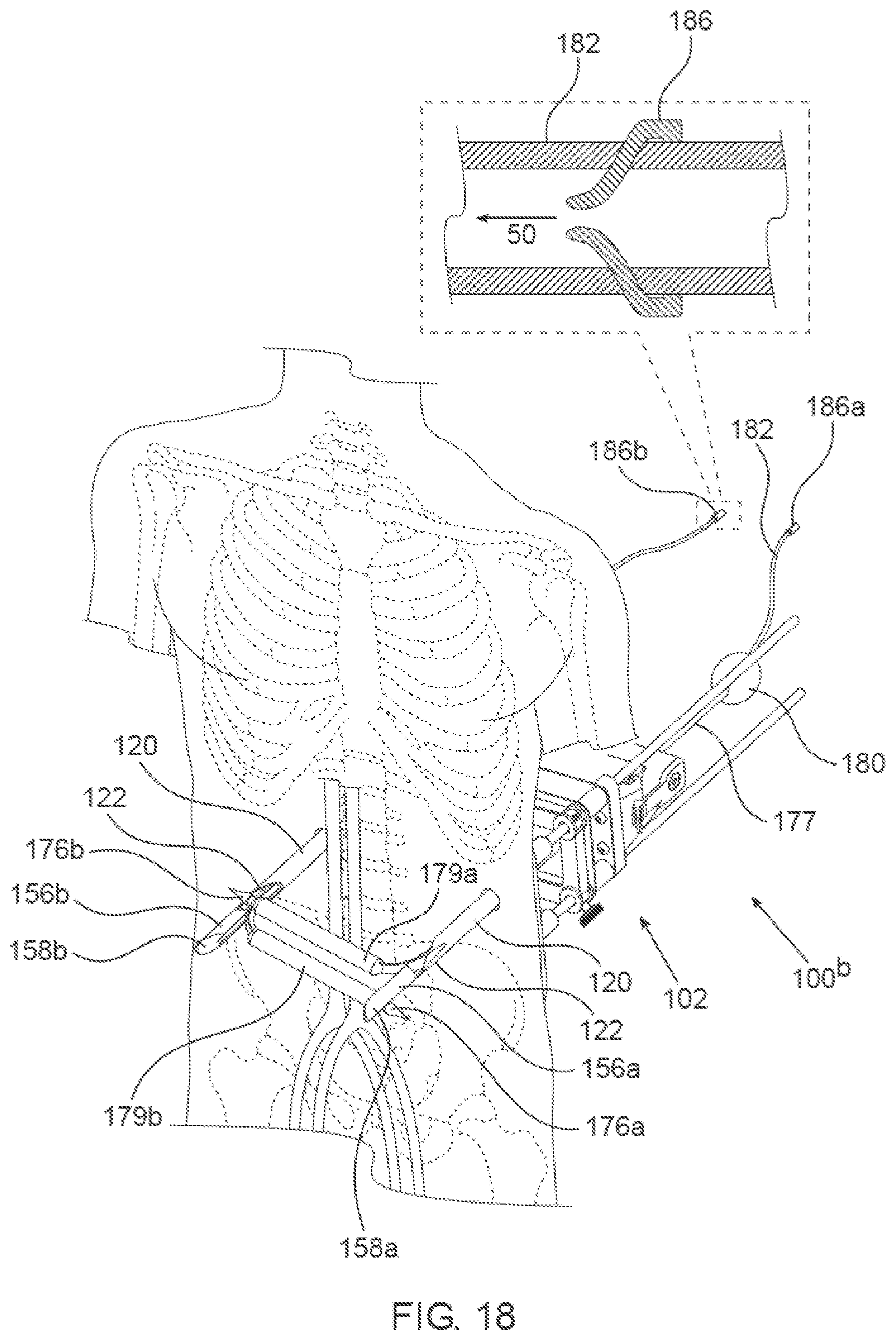 Patent US12564405 Figure 19 – Blood vessel compression systems