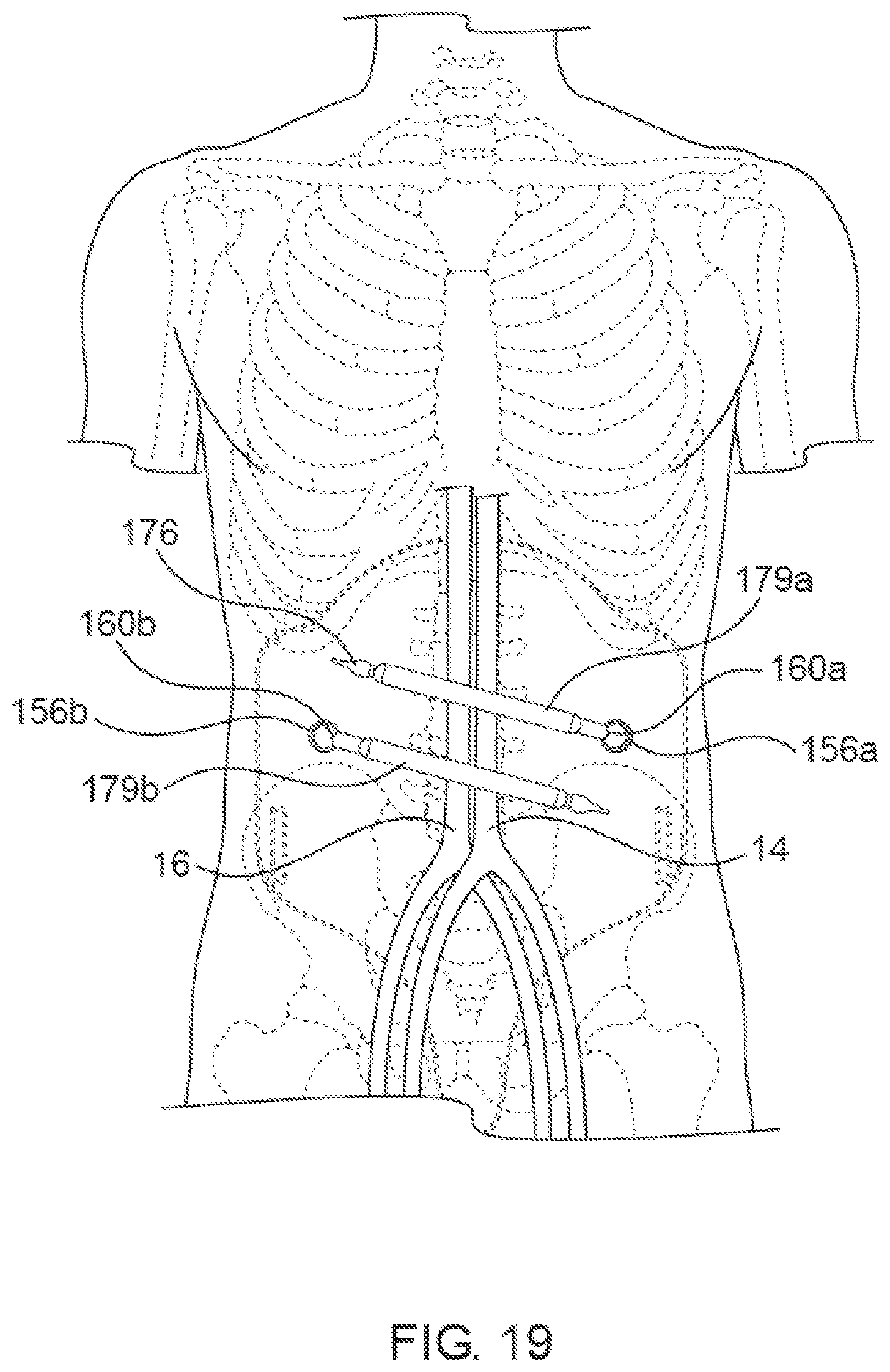 Patent US12564405 Figure 20 – Blood vessel compression systems