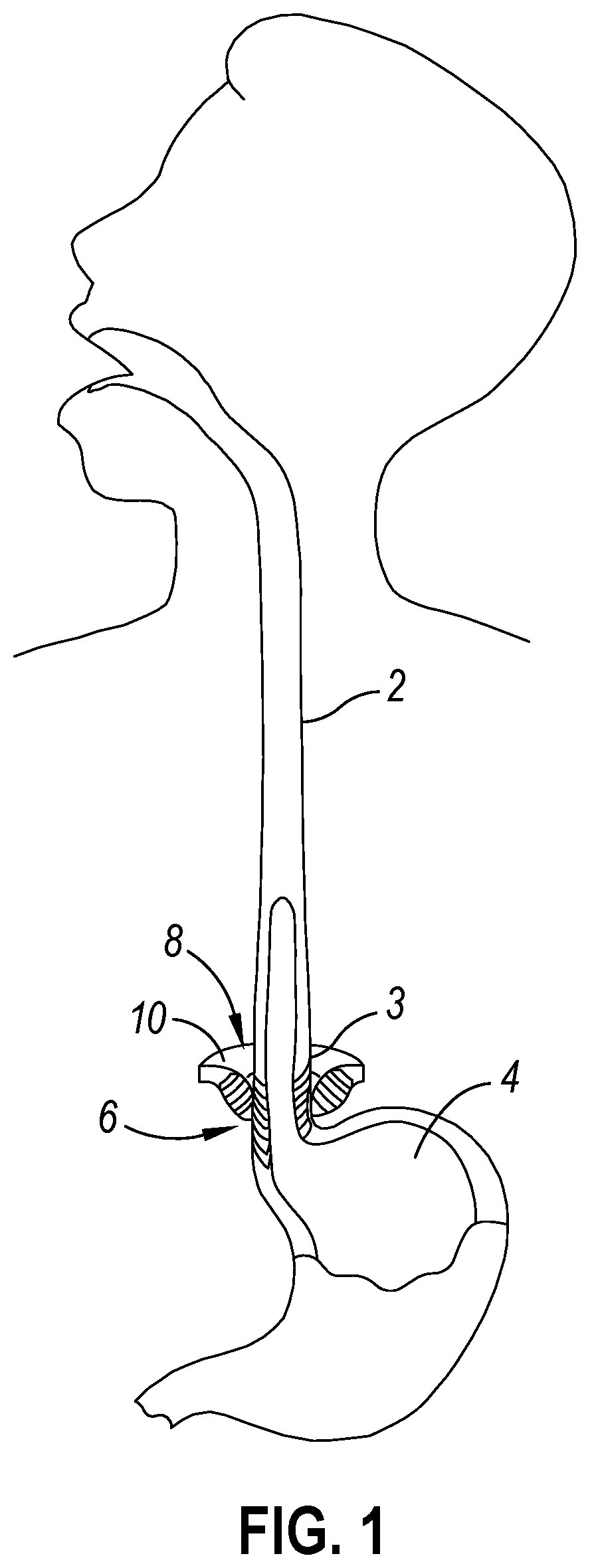 Patent US12564406 Figure 1 – Implantable sphincter assistance device with bimodal circumferential restriction force threshold