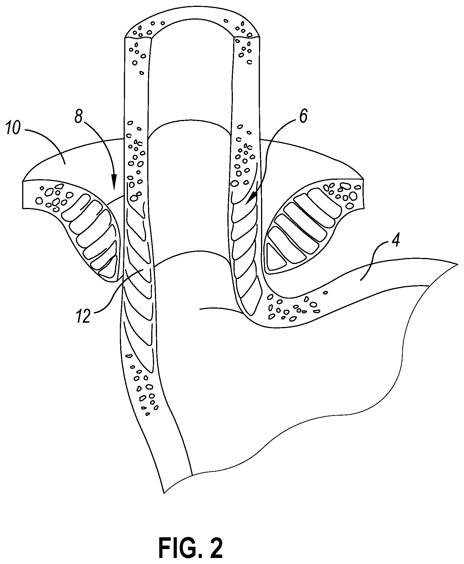 Patent US12564406 Figure 2 – Implantable sphincter assistance device with bimodal circumferential restriction force threshold