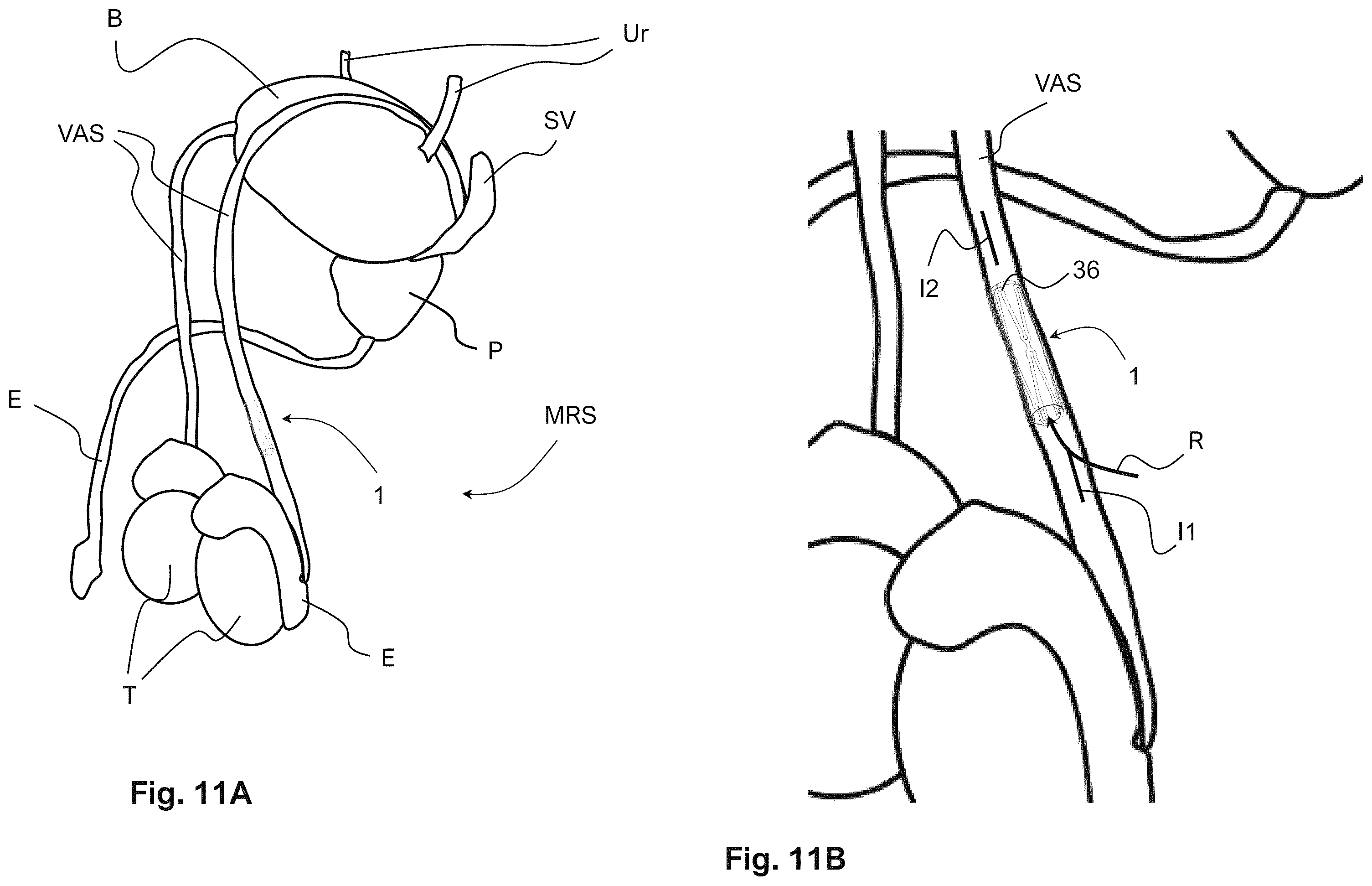 Patent US12564407 Figure 13 – Reversible occlusion device, system and method