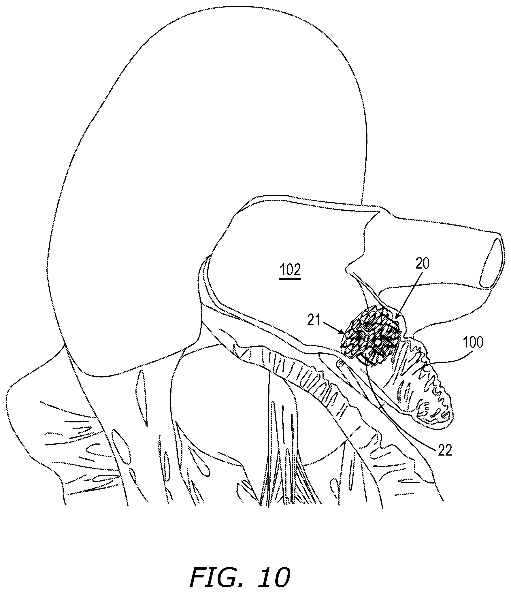 Patent US12564408 Figure 19 – Medical occluder delivery systems