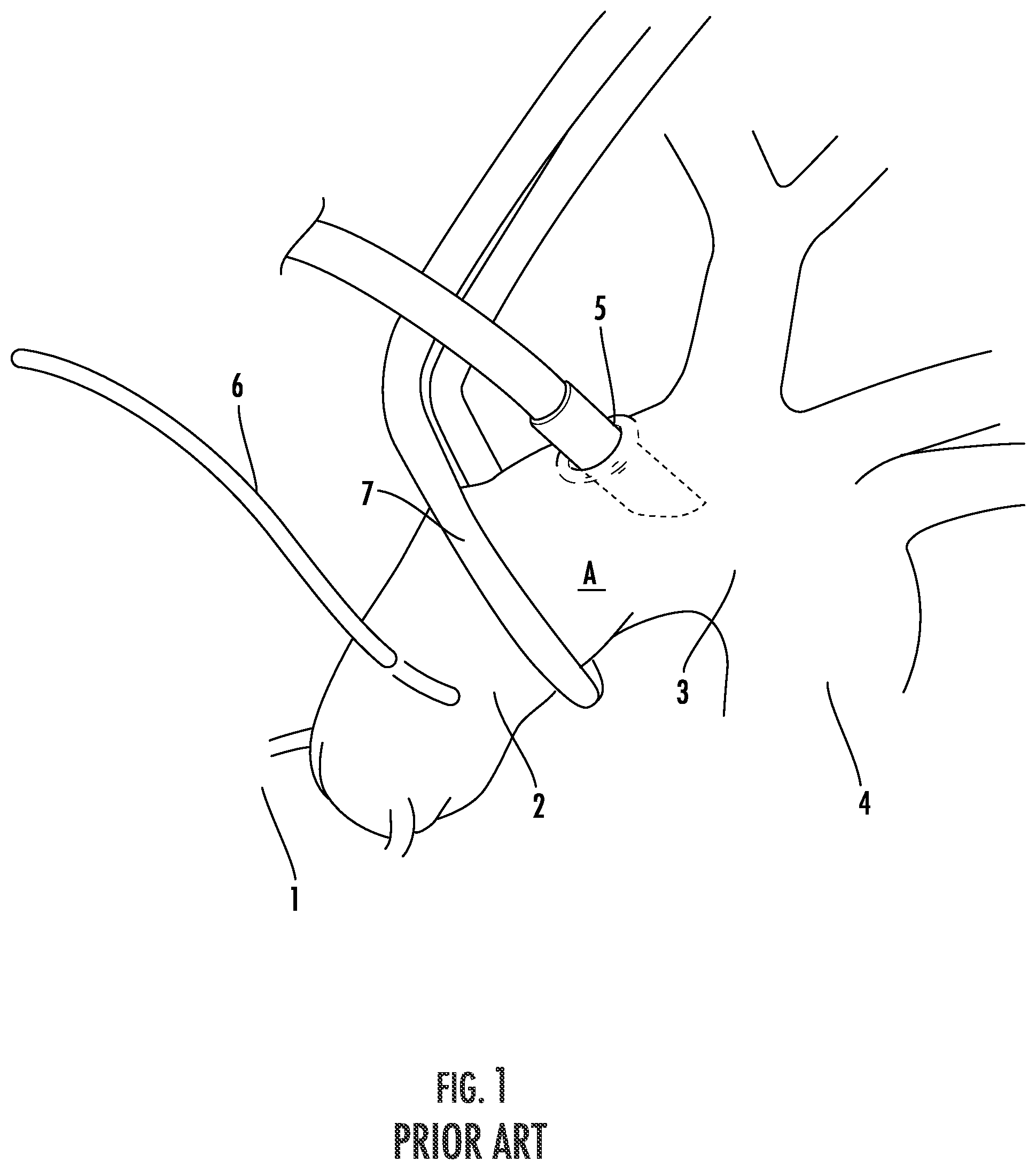Patent US12564409 Figure 1 – Double lumen aortic cannula and cross clamp assembly and related methods