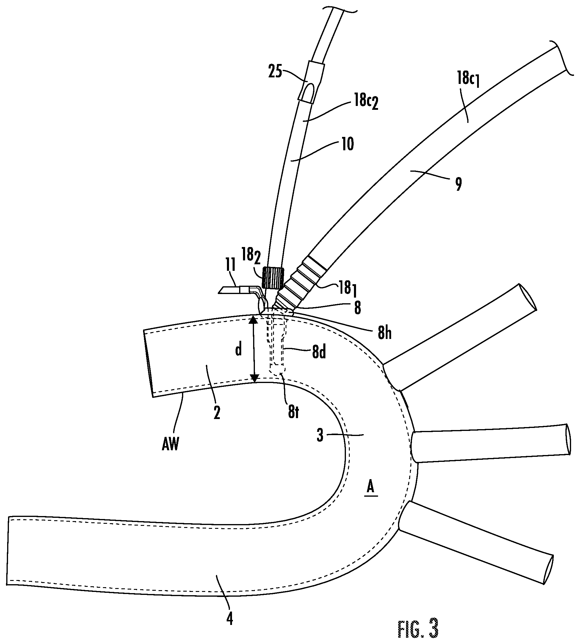 Patent US12564409 Figure 3 – Double lumen aortic cannula and cross clamp assembly and related methods