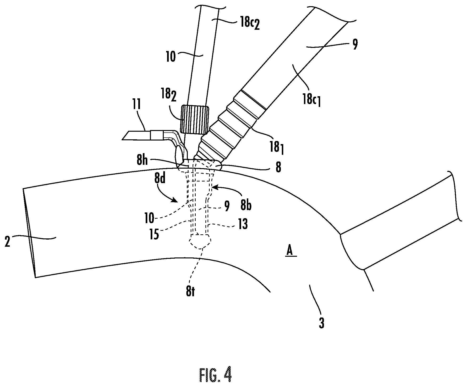 Patent US12564409 Figure 4 – Double lumen aortic cannula and cross clamp assembly and related methods
