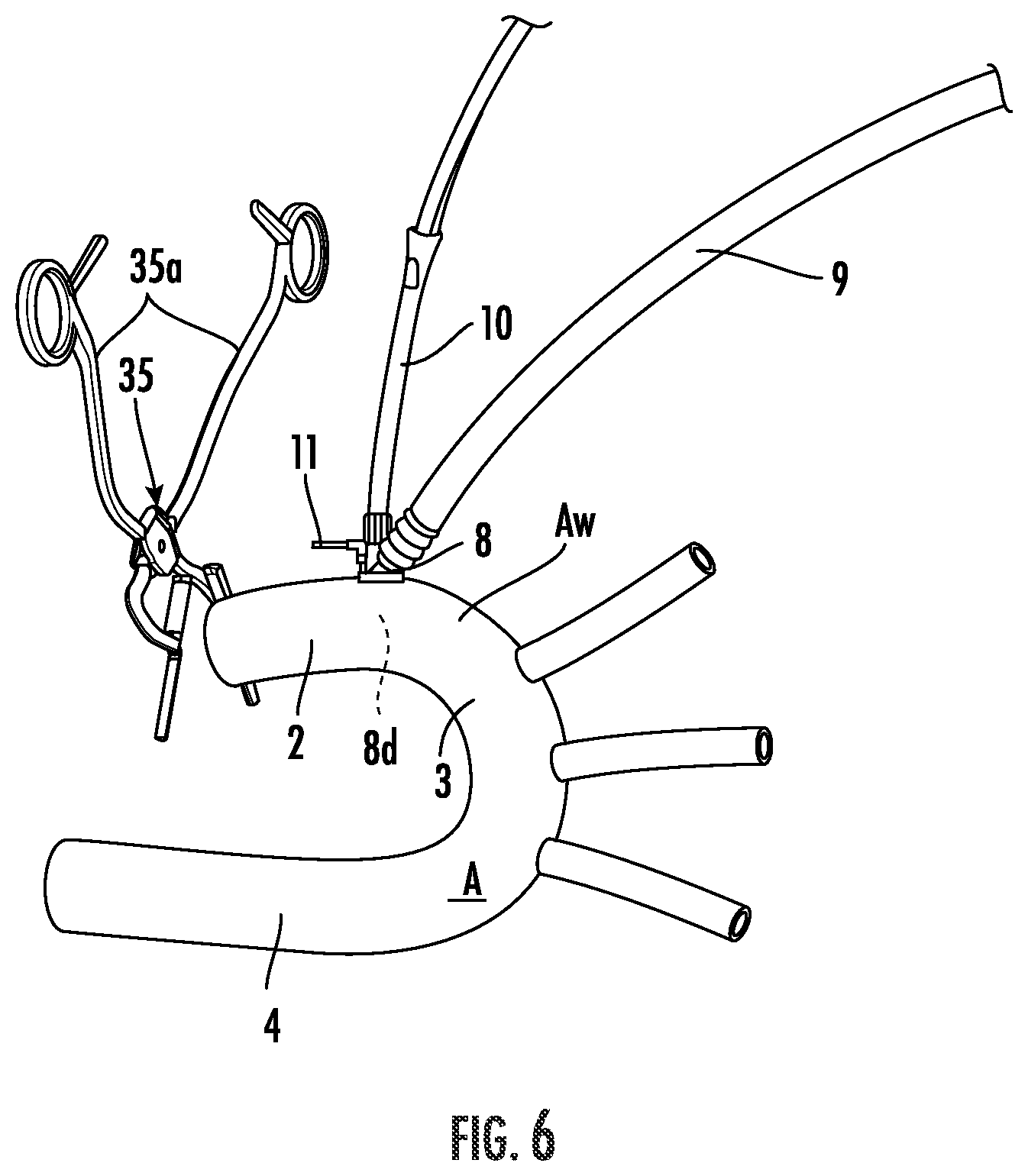 Patent US12564409 Figure 6 – Double lumen aortic cannula and cross clamp assembly and related methods