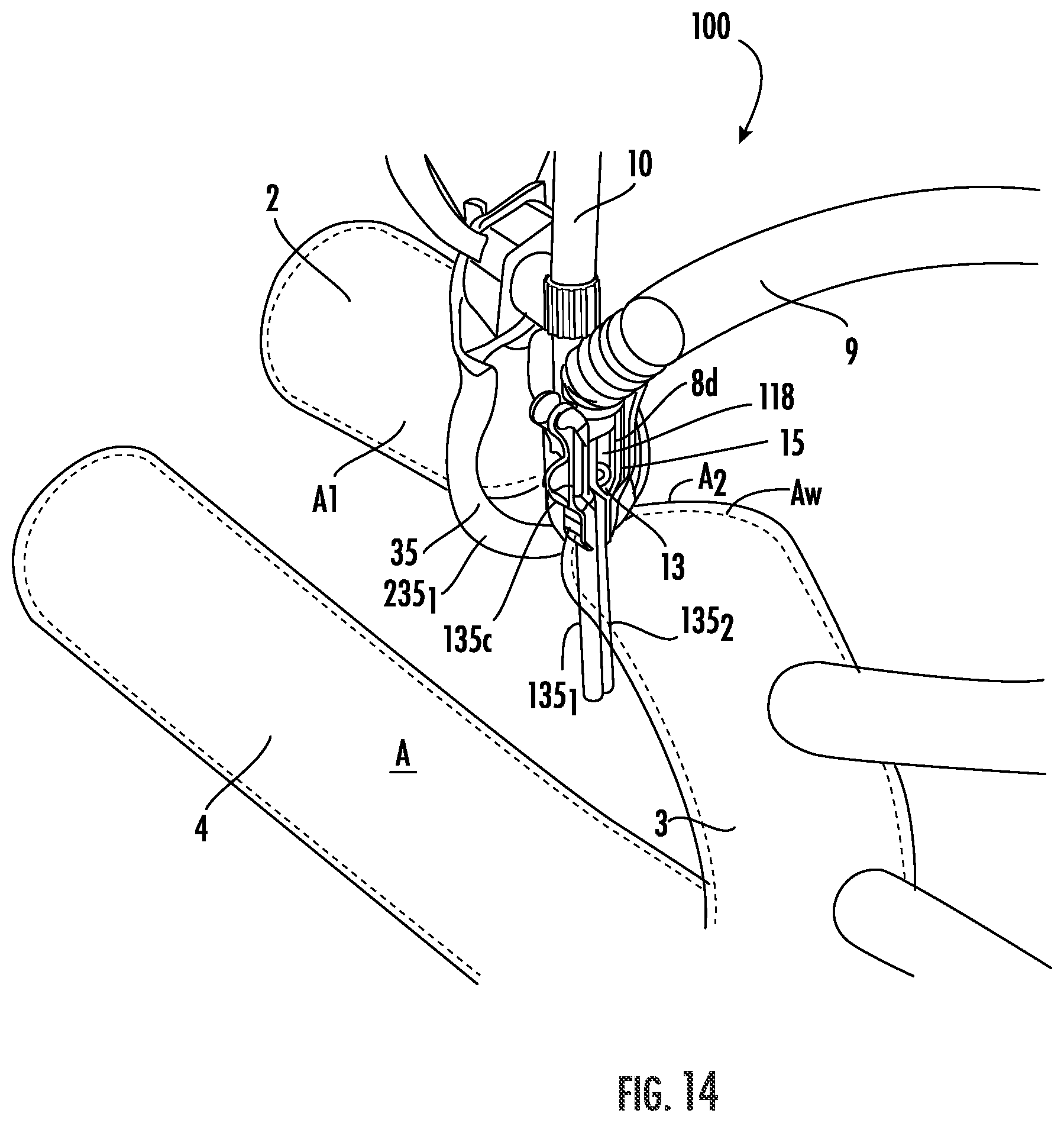Patent US12564409 Figure 14 – Double lumen aortic cannula and cross clamp assembly and related methods