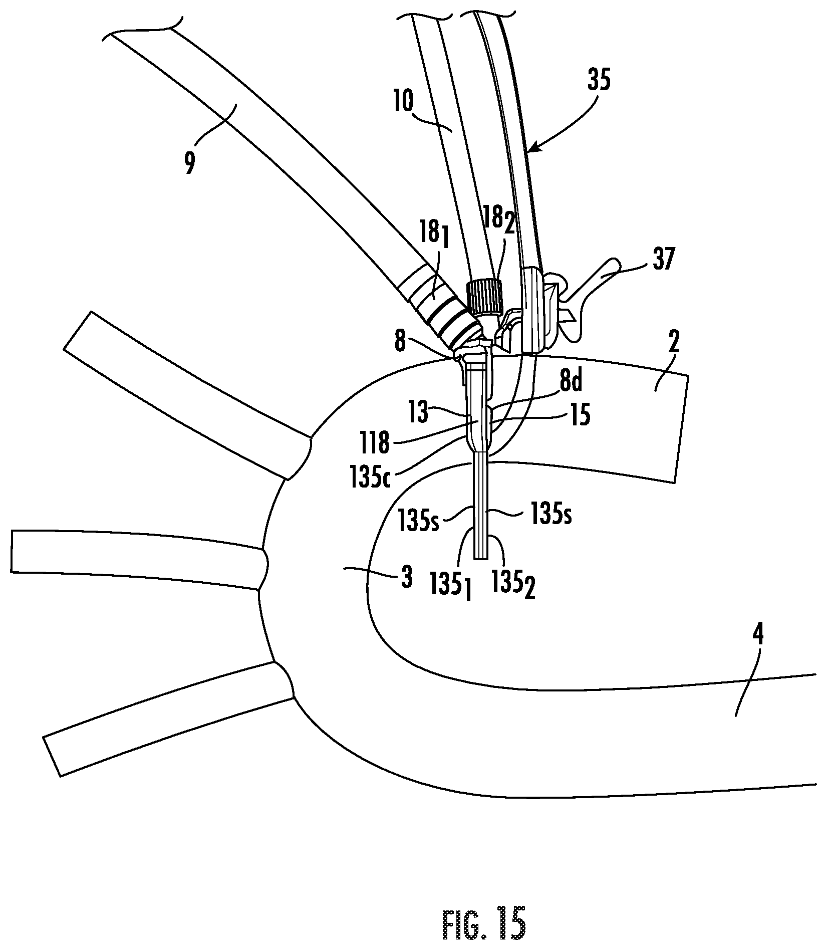 Patent US12564409 Figure 15 – Double lumen aortic cannula and cross clamp assembly and related methods