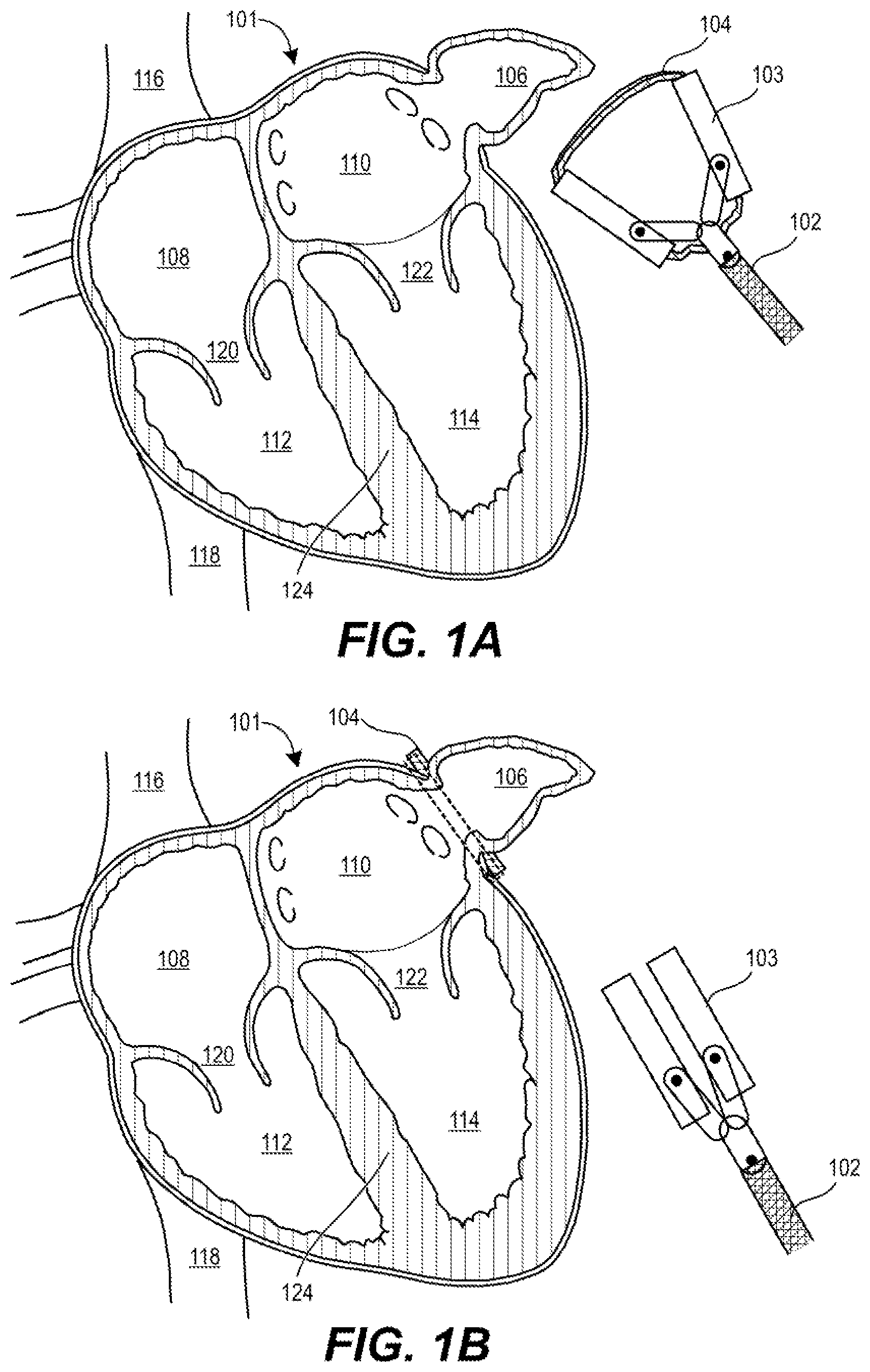 Patent US12564411 — Friction compensating, even pressure clip — Figure 1