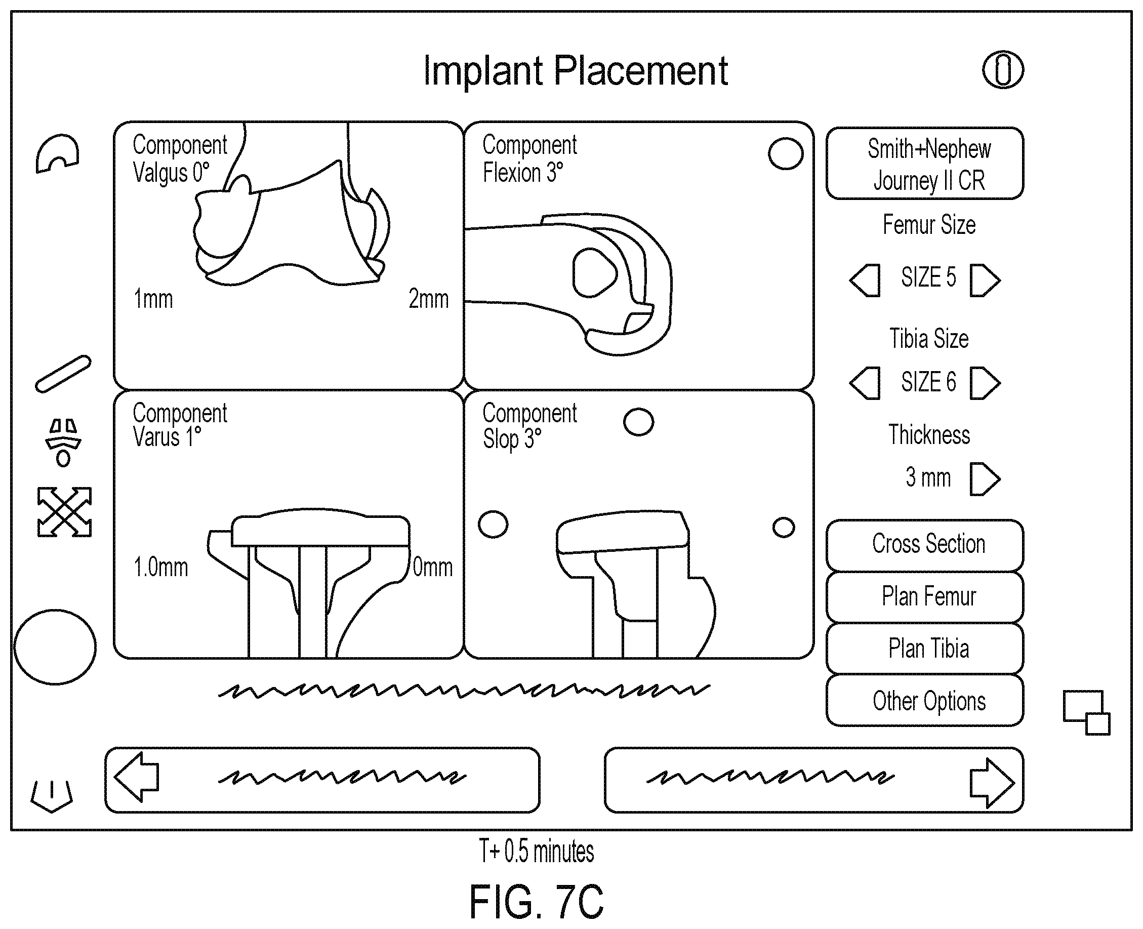 Patent US12564413 Figure 11 – Registration of intramedullary canal during revision total knee arthroplasty