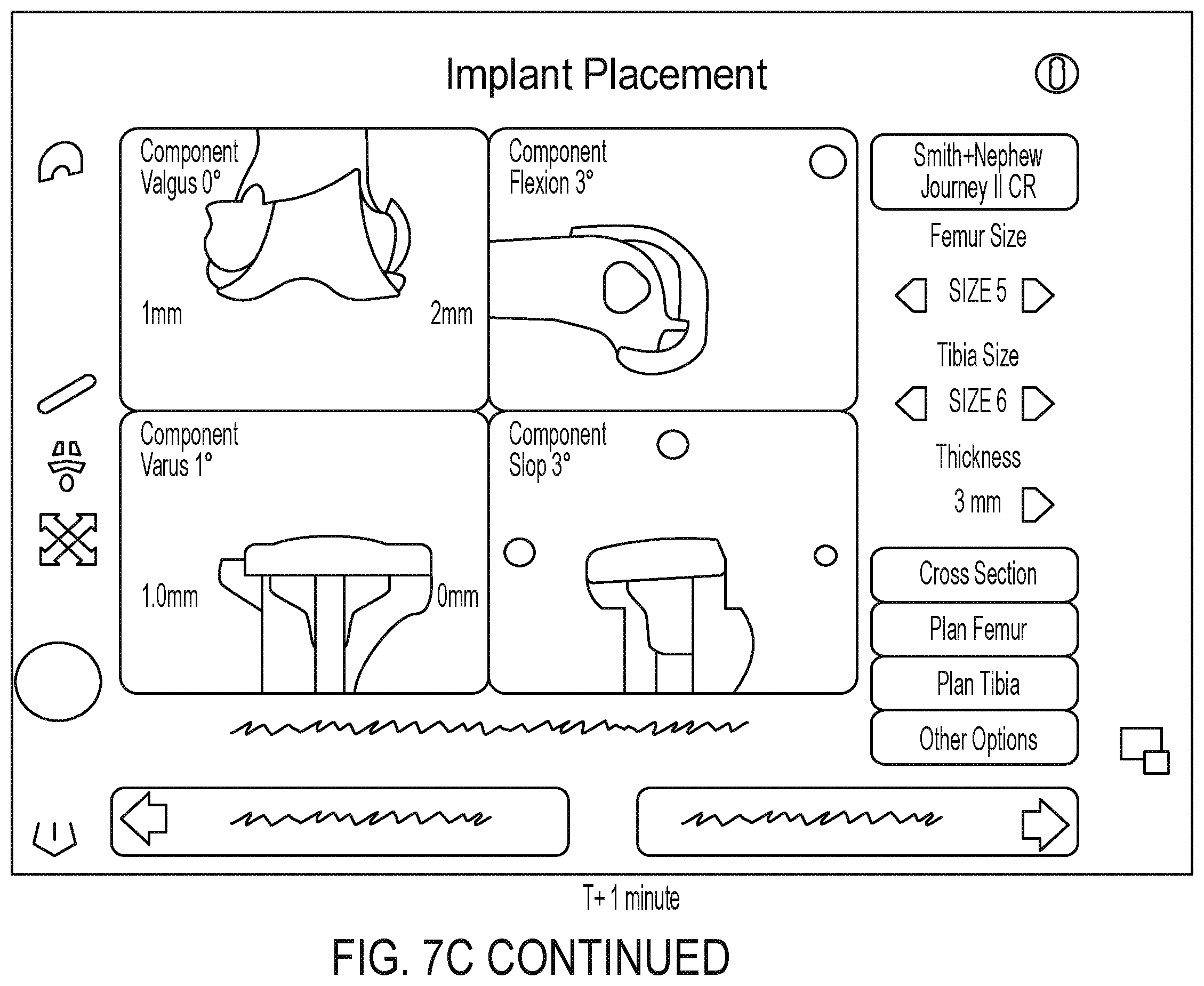 Patent US12564413 Figure 12 – Registration of intramedullary canal during revision total knee arthroplasty