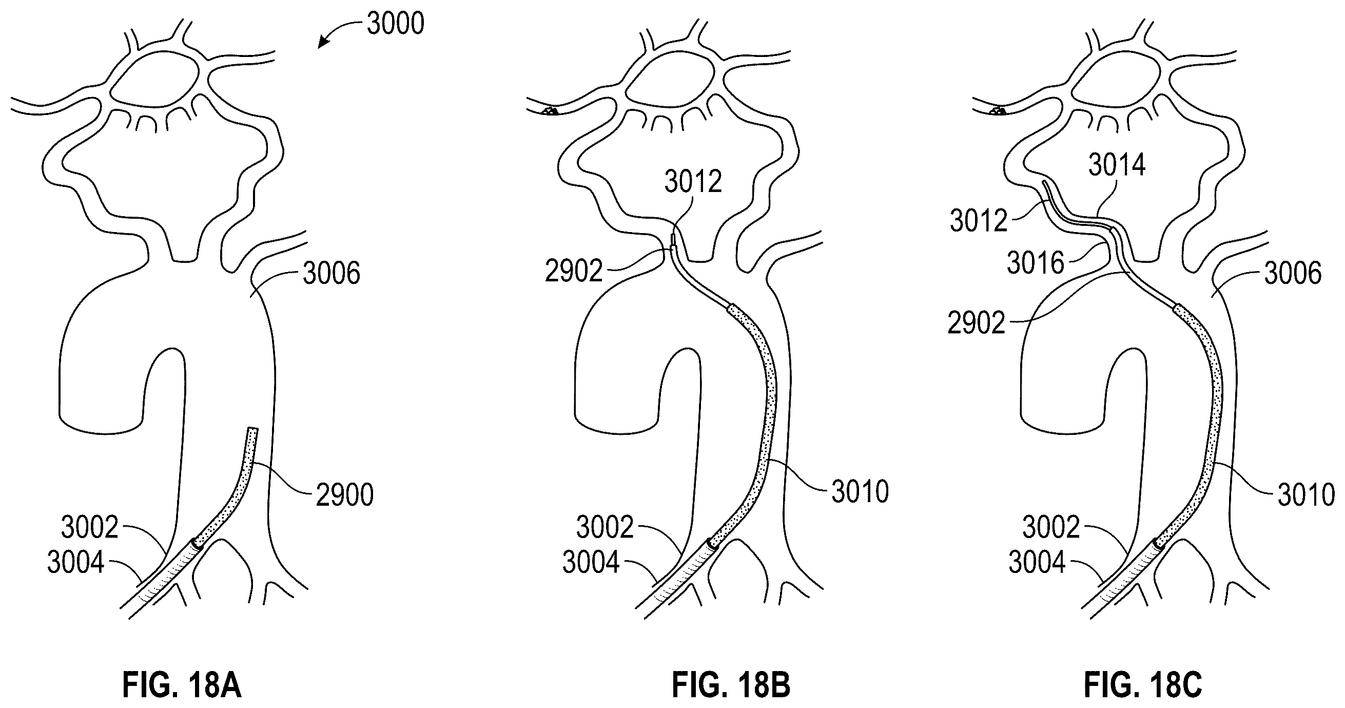 Patent US12564414 Figure 20 – Method of supra-aortic access for a neurovascular procedure