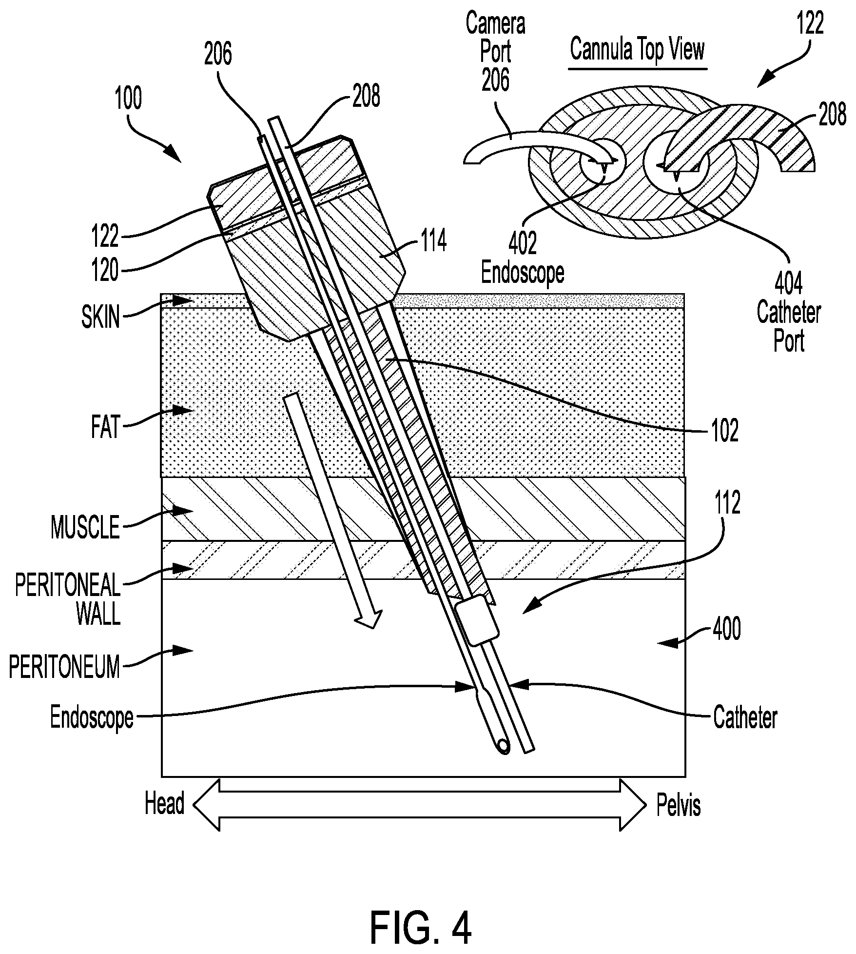 Patent US12564421 Figure 4 – Peritoneal trocar apparatus and system