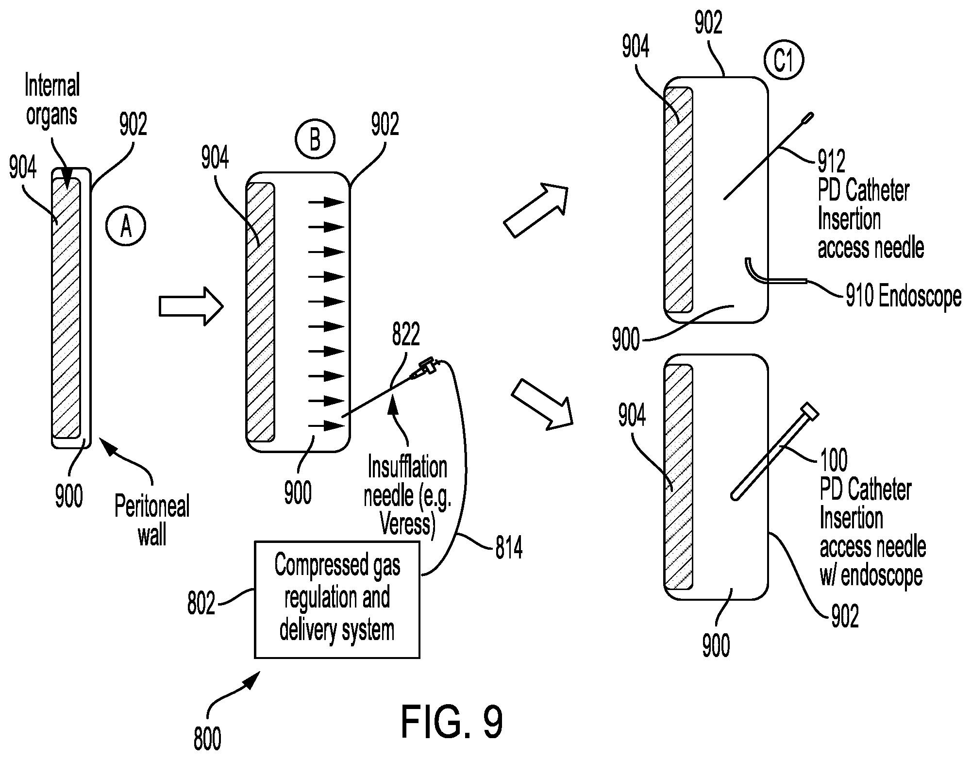 Patent US12564421 Figure 11 – Peritoneal trocar apparatus and system